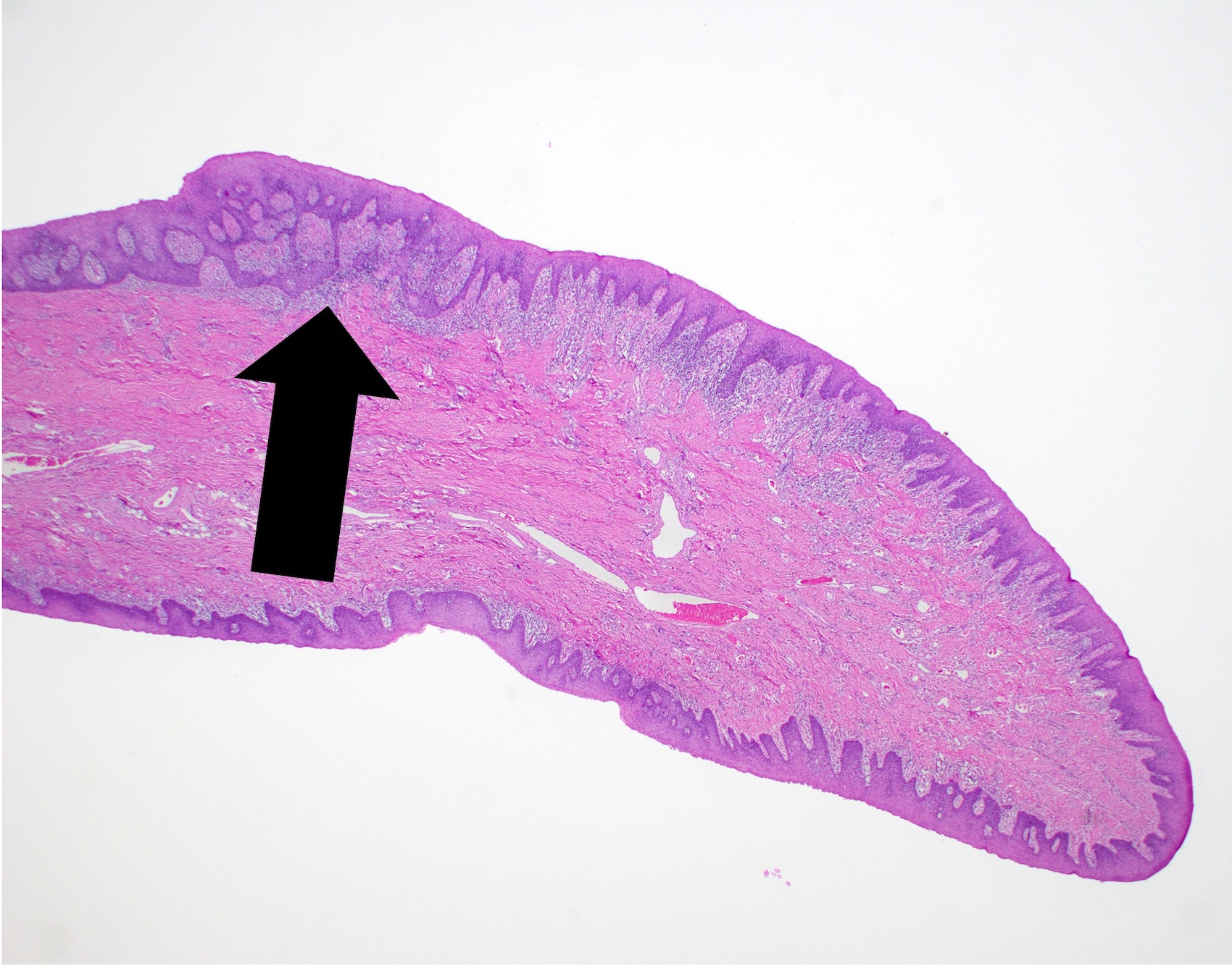 Epulis Fissuratum Histologie