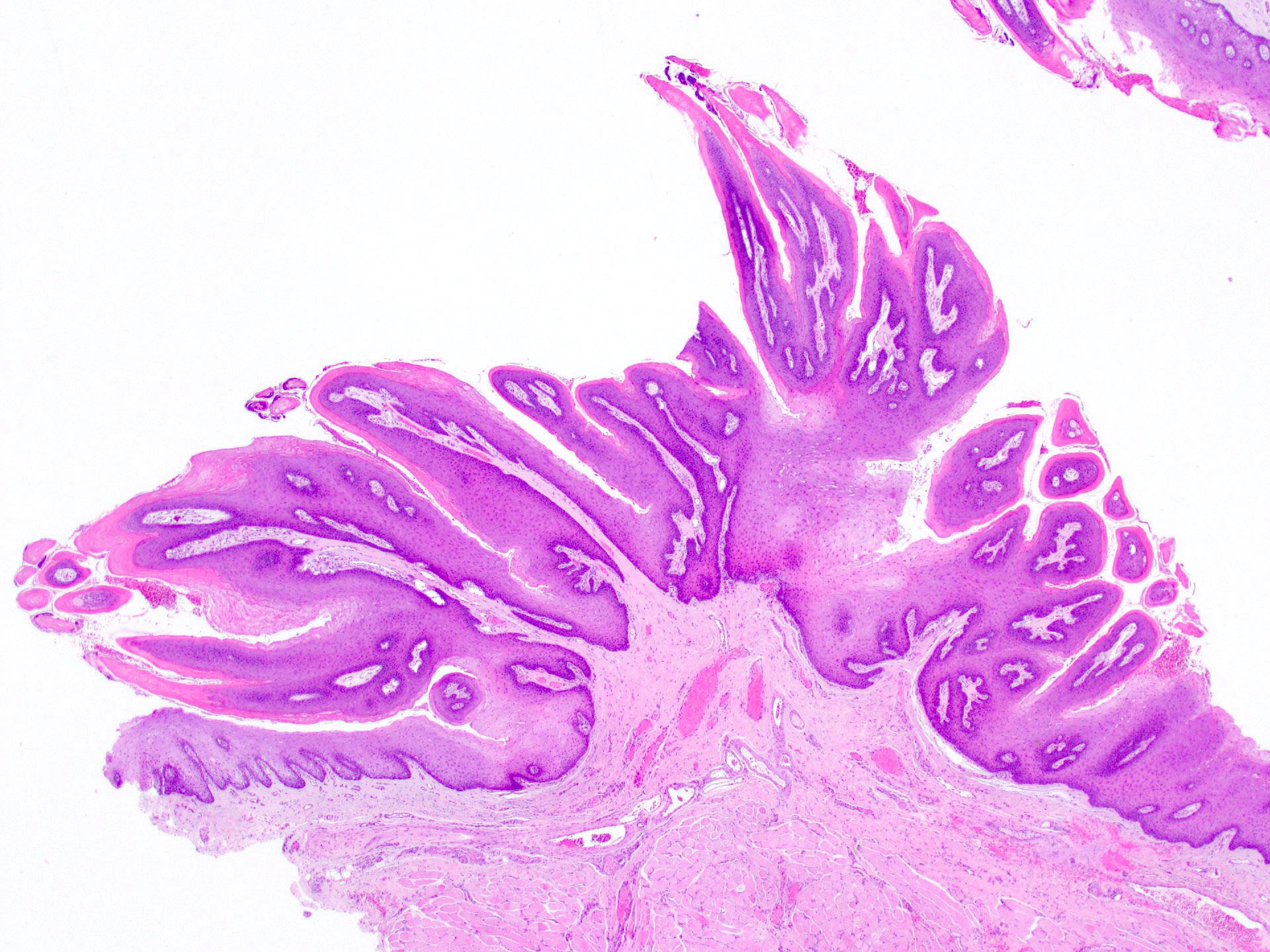 tongue papilloma pathology outlines dispozitive antihelmintice umane