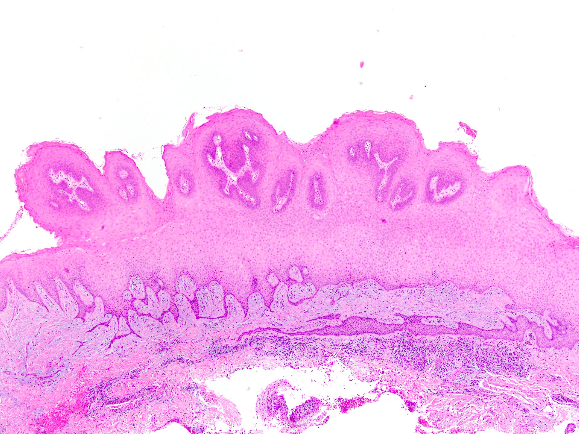 papilloma skin pathology outlines