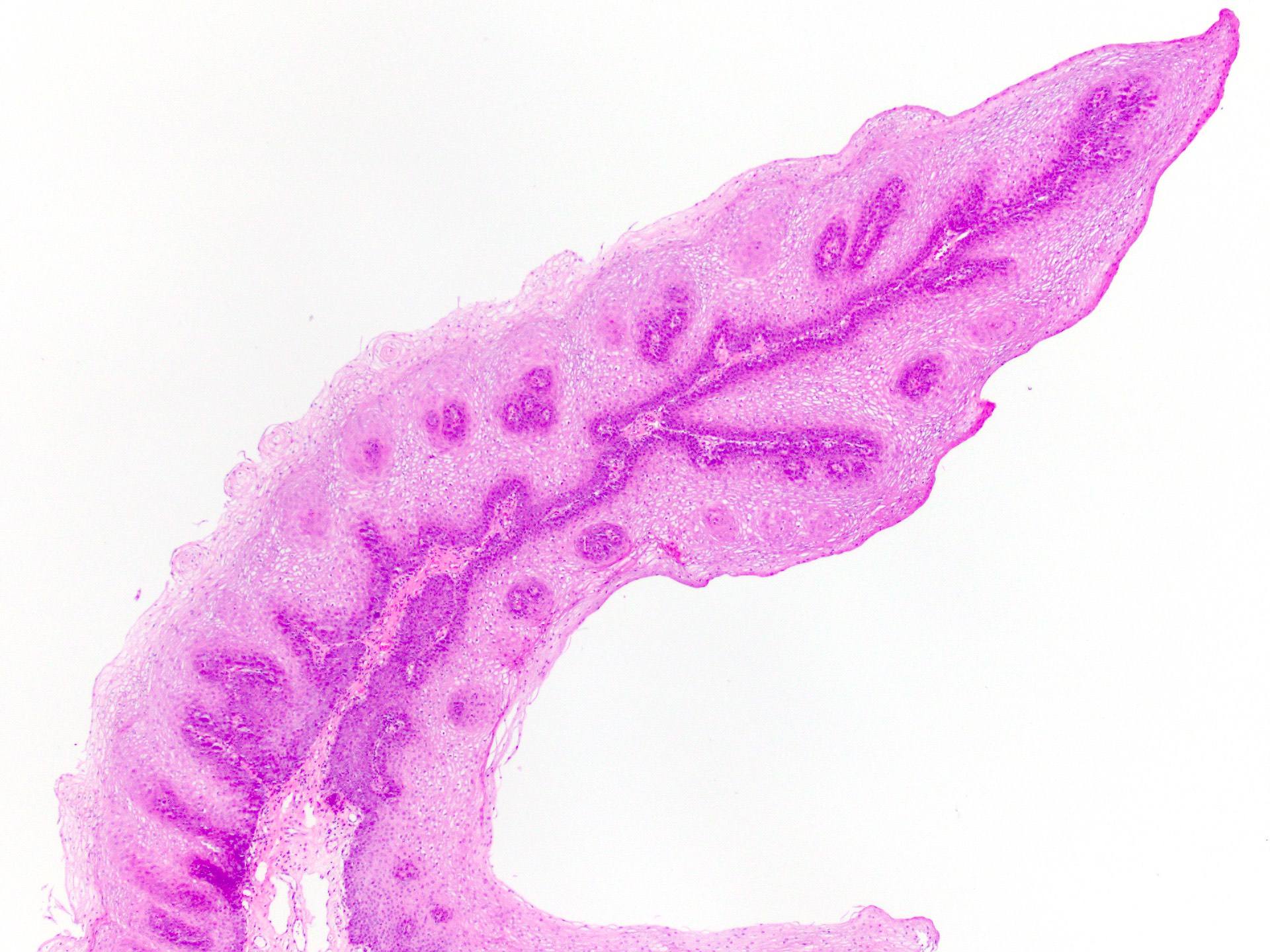 Papilloma tongue pathology outlines