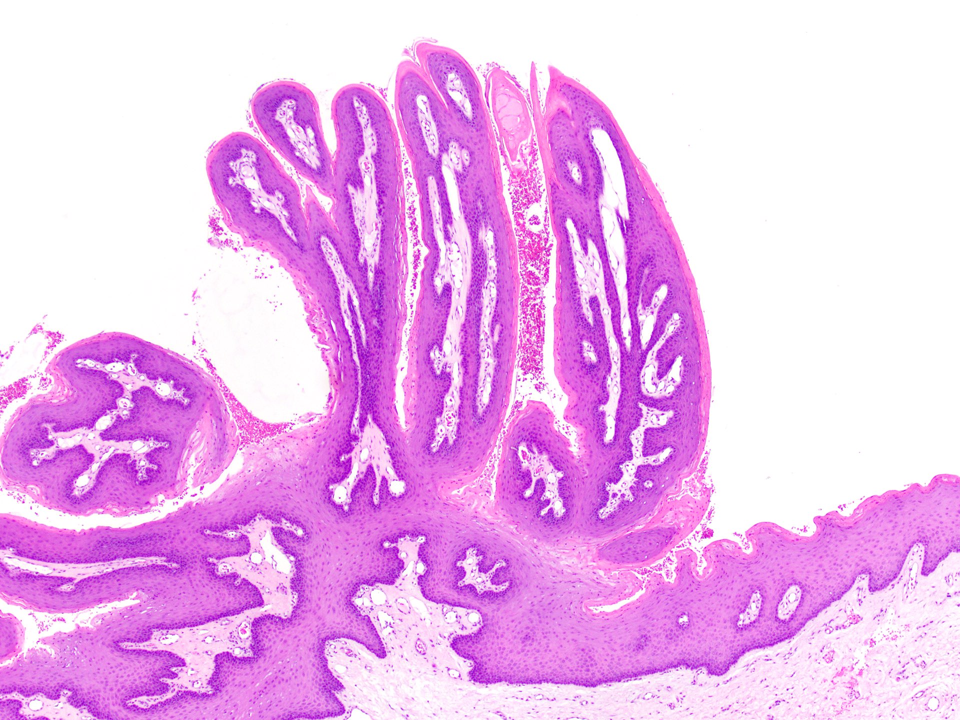 papilloma pathology outlines skin