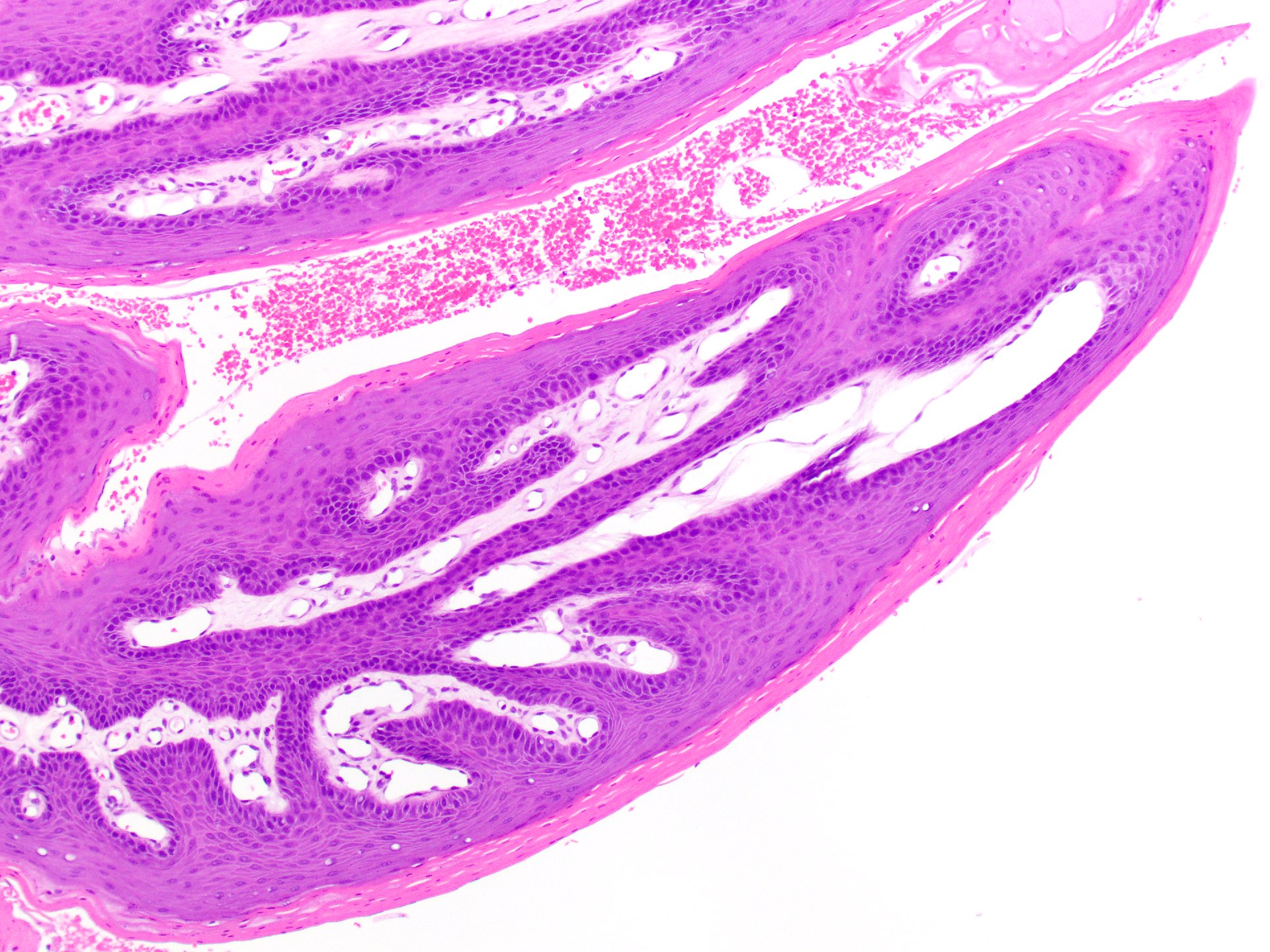 squamous cell papilloma larynx pathology outlines