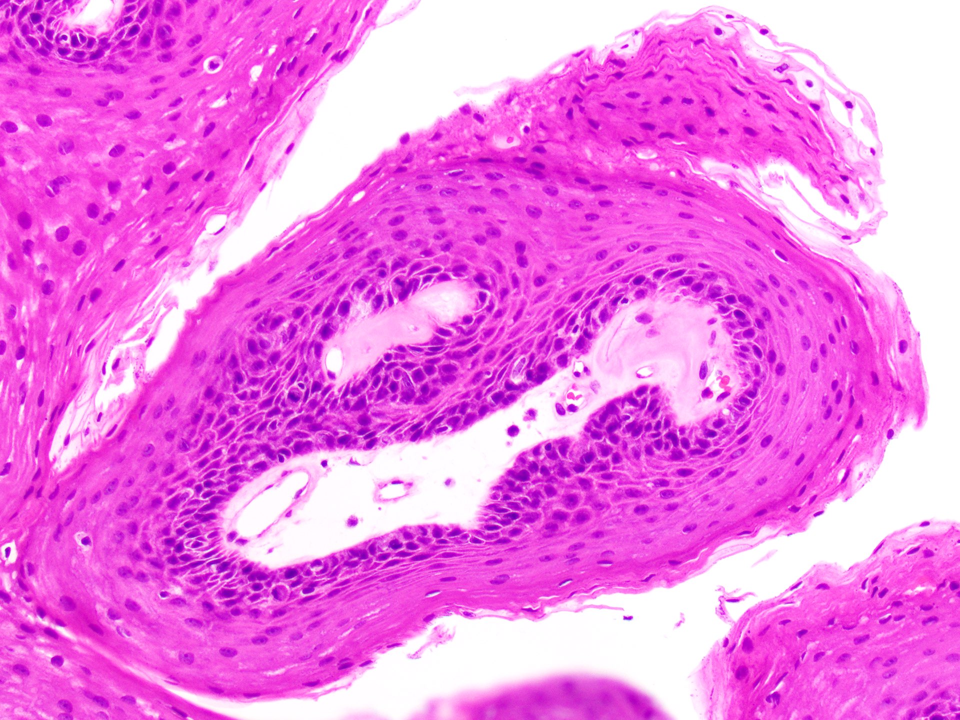 papilloma pathology outlines skin