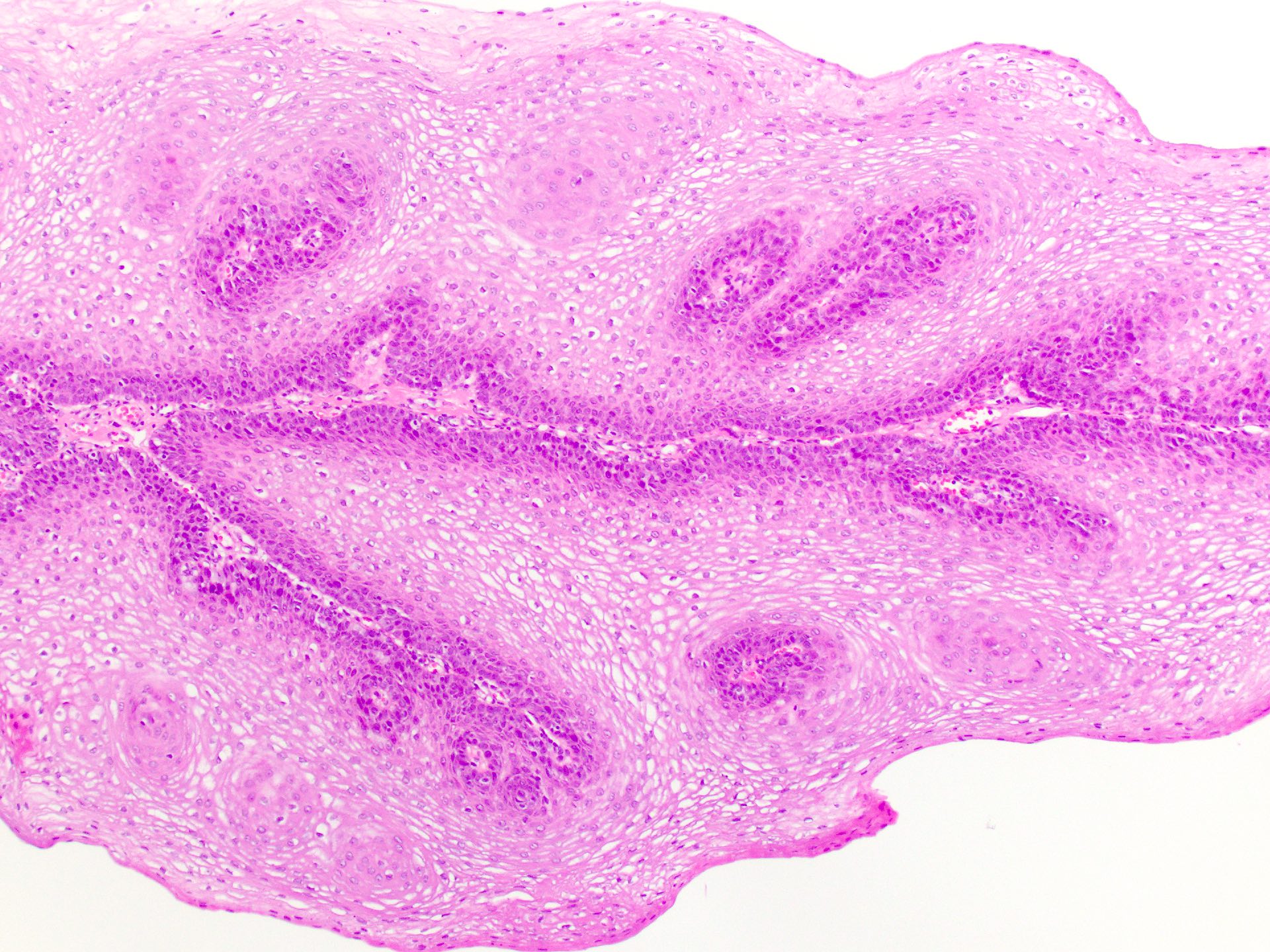 squamous papilloma path outlines