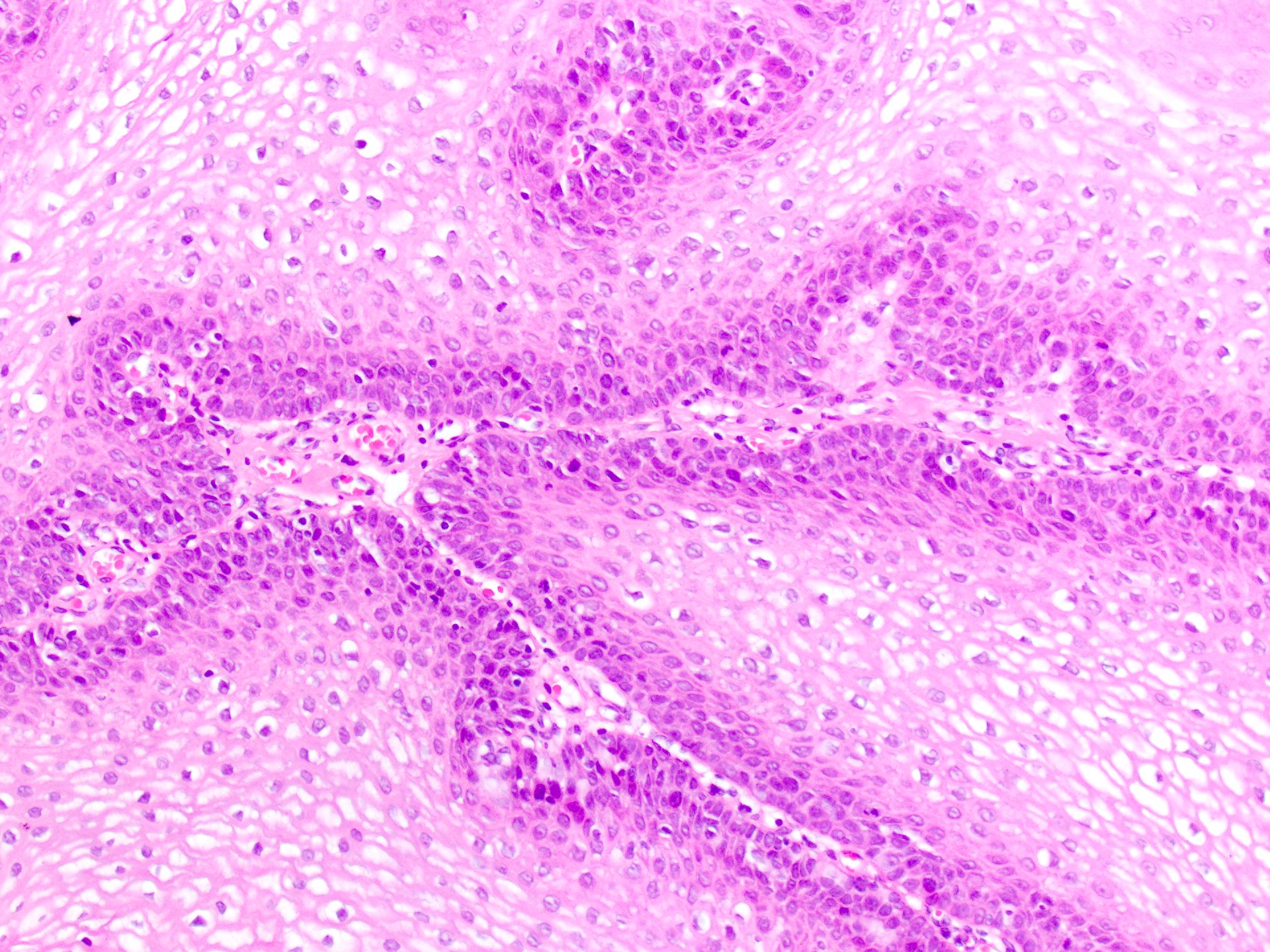 squamous cell papilloma icd 10