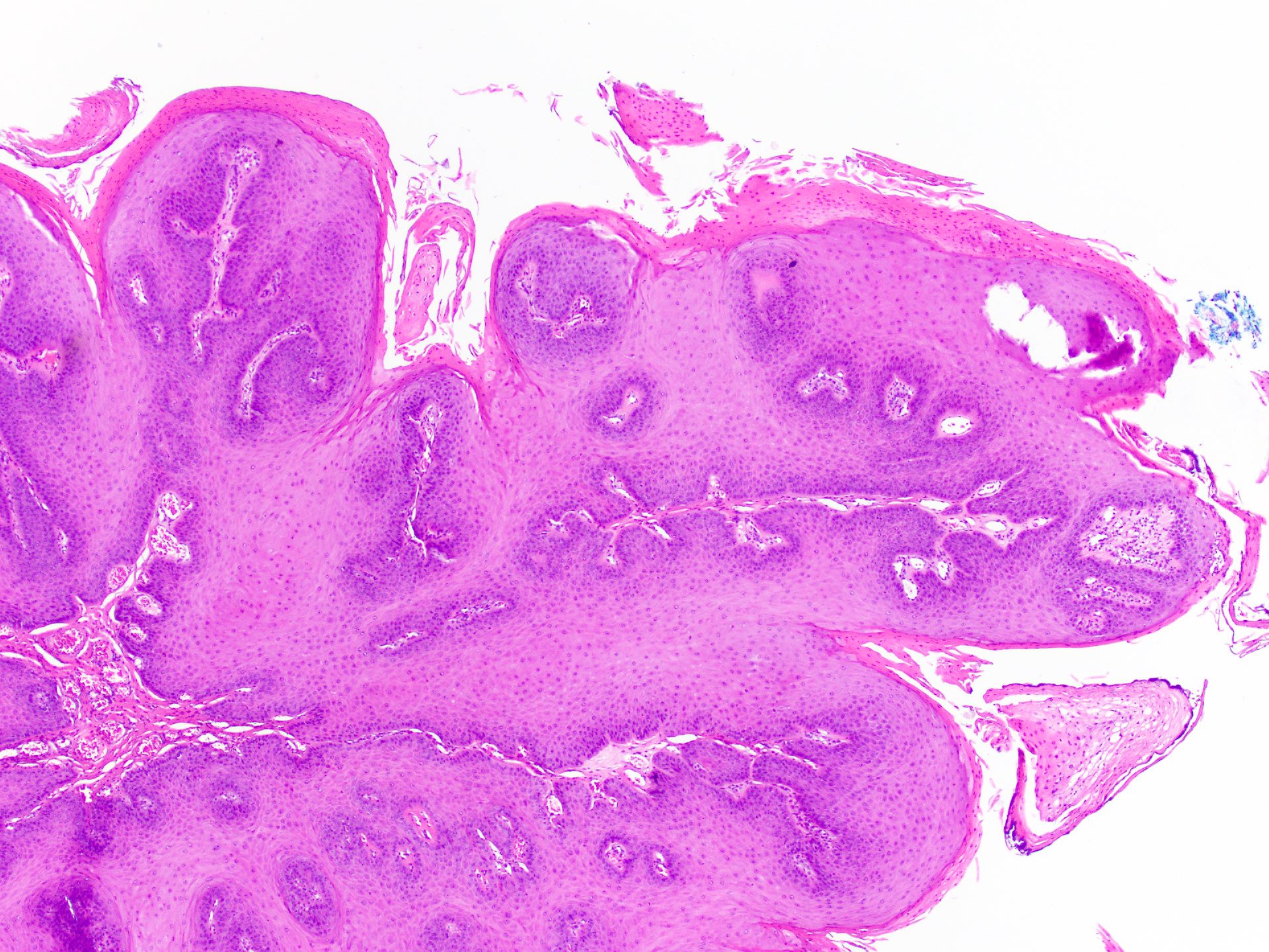 Squamous papilloma in tongue, Papillary urothelial hyperplasia bladder, Squamous papilloma def