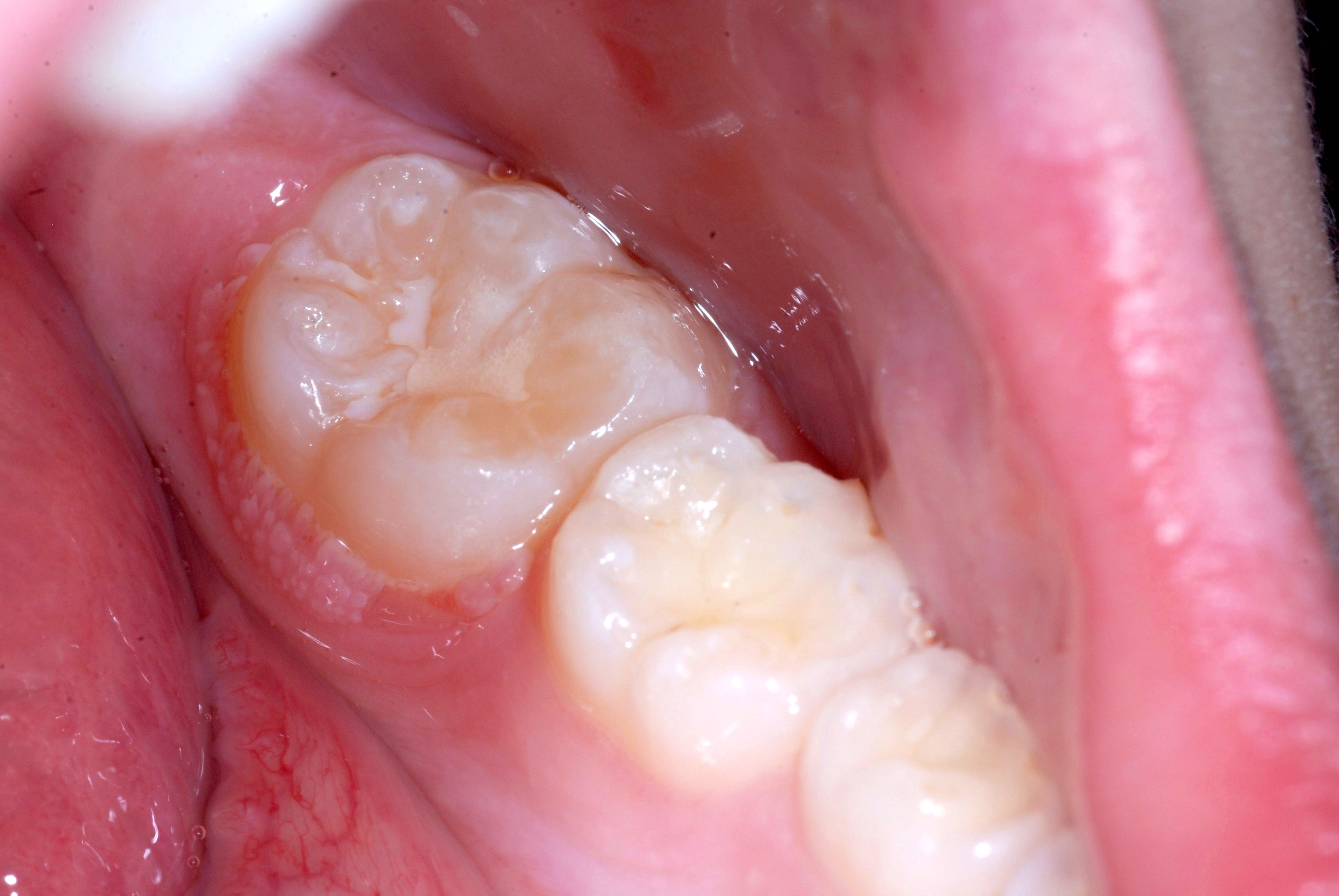 Squamous cell papilloma mouth - Squamous papilloma of mouth