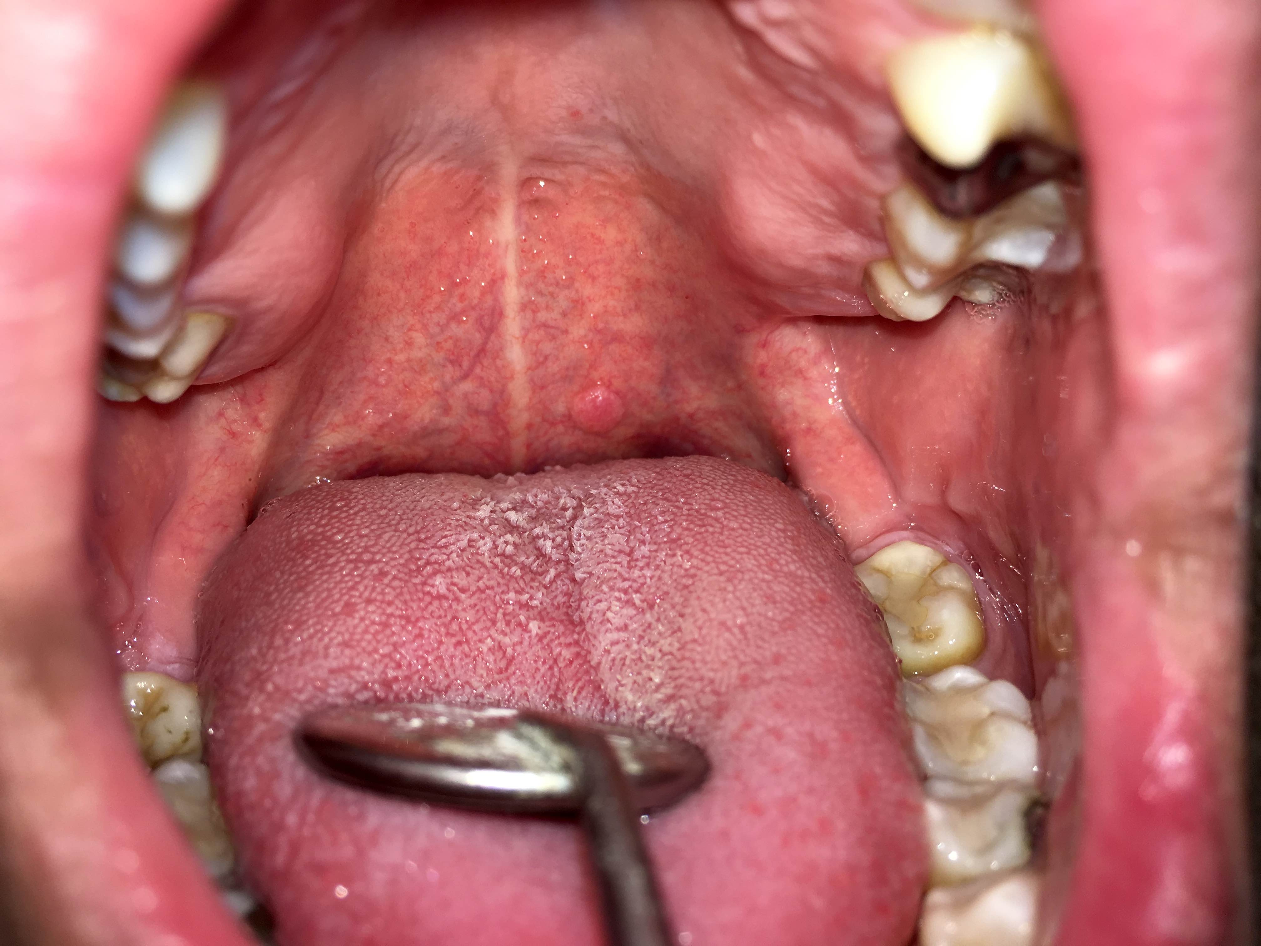 A szájüregi rák és tünetei - A nyelv laphámsejtes papilloma