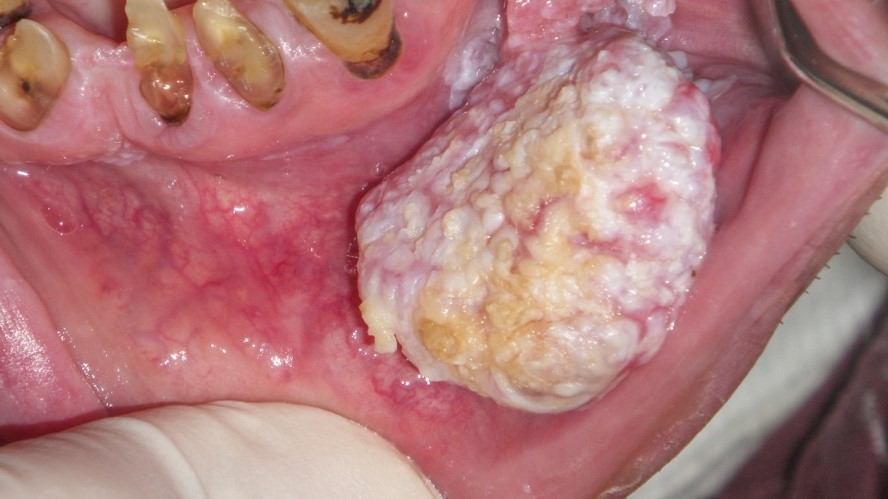 Exophytic verrucoid labial mass
