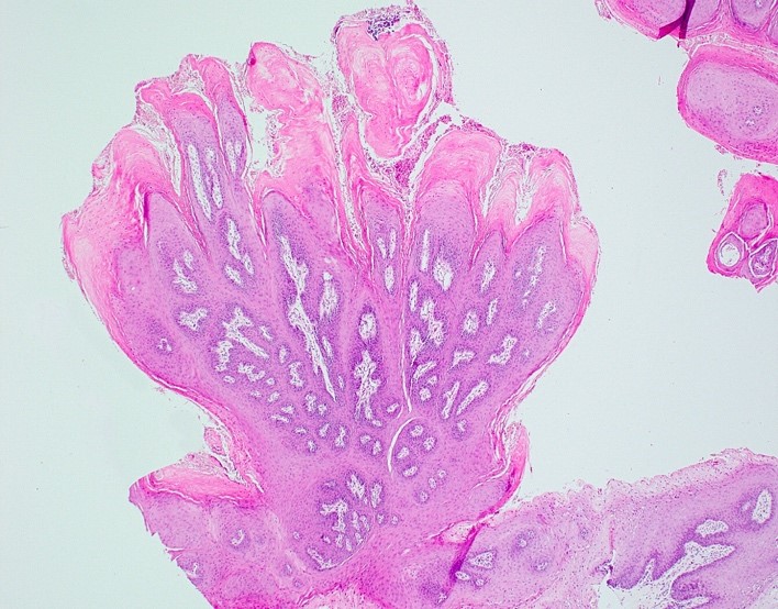 Papilloma histology