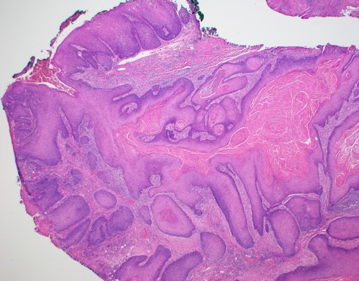 Carcinoma cuniculatum
