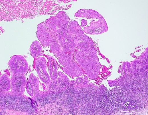 Papillary squamous cell carcinoma
