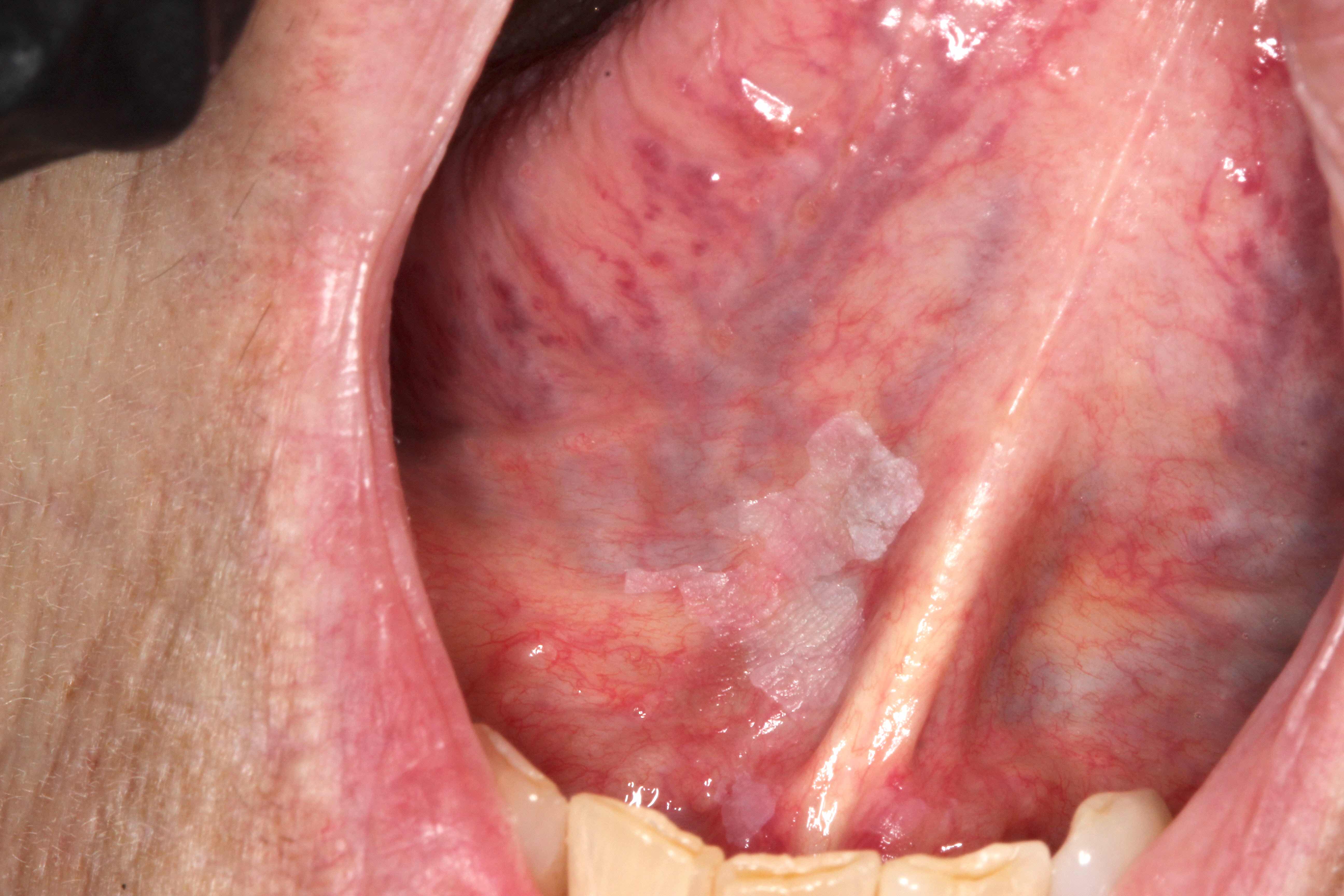 Leukoplakia on ventral tongue