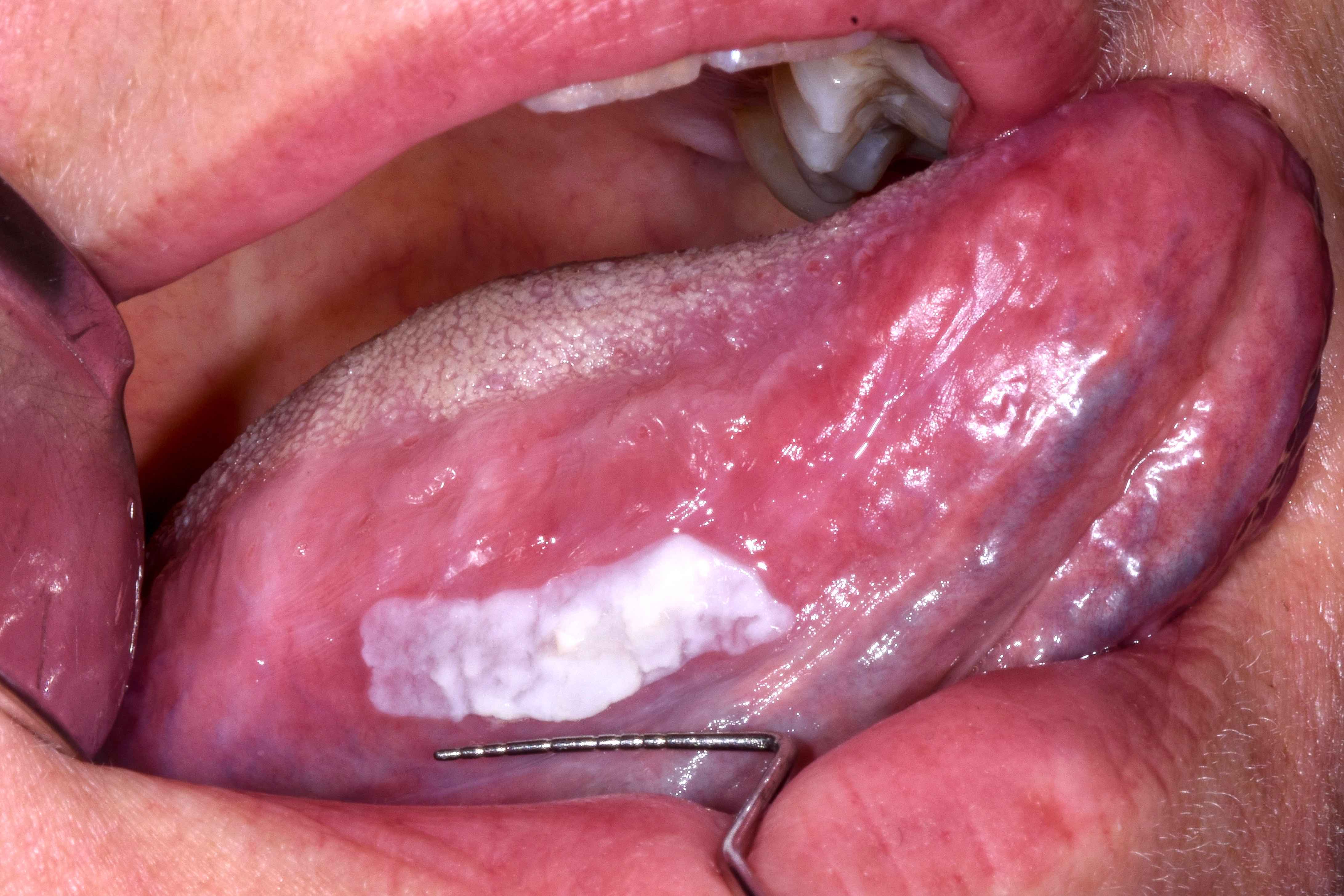 Tongue lesion