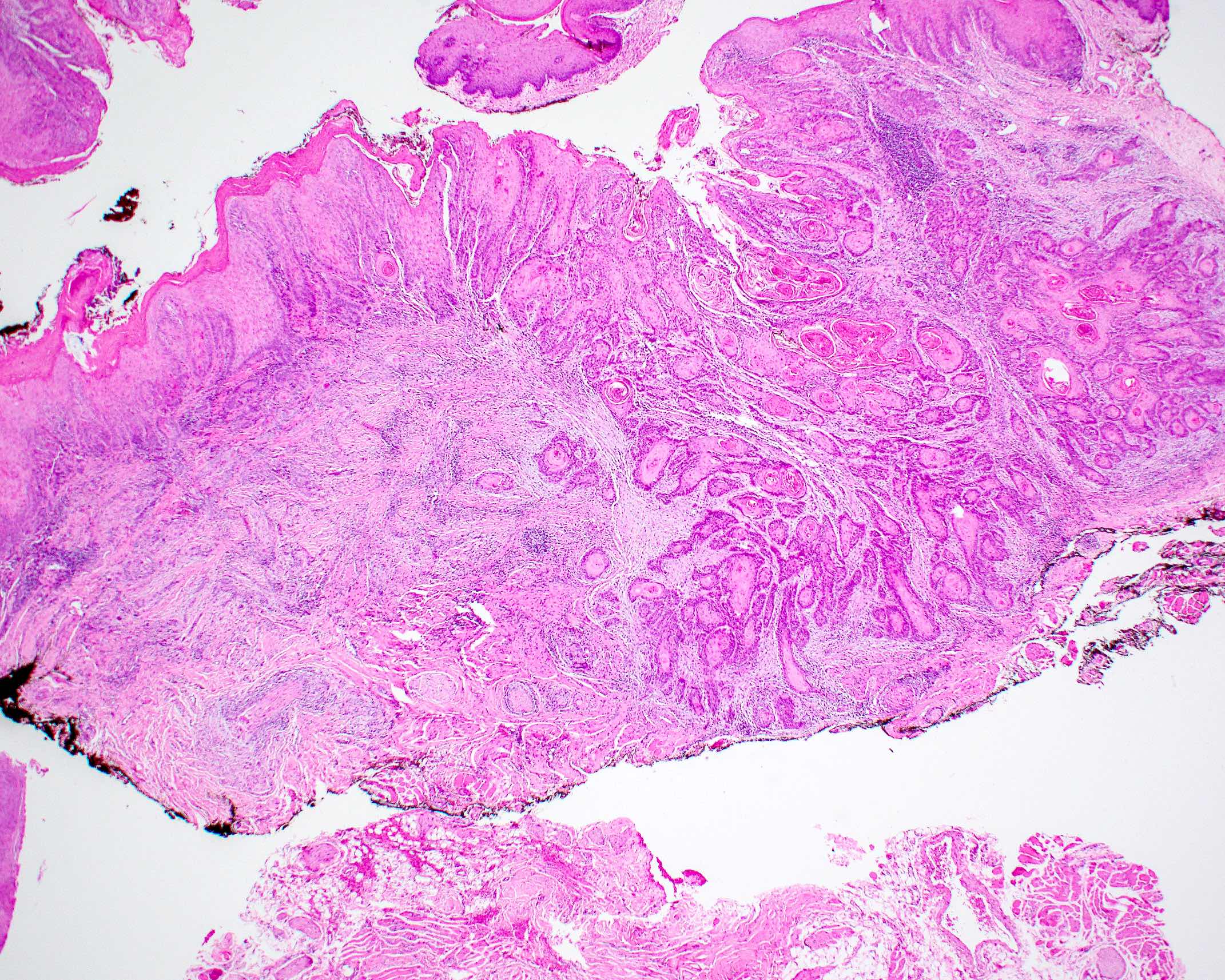 Squamous cell carcinoma transformation