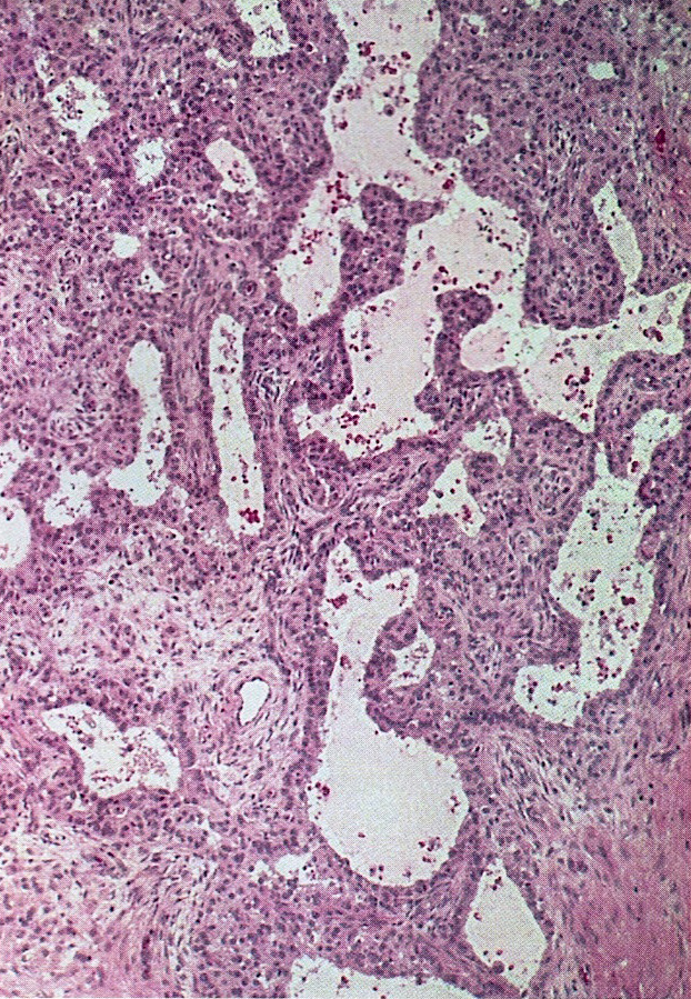 Solid cellular neoplasm with focal follicle formation
