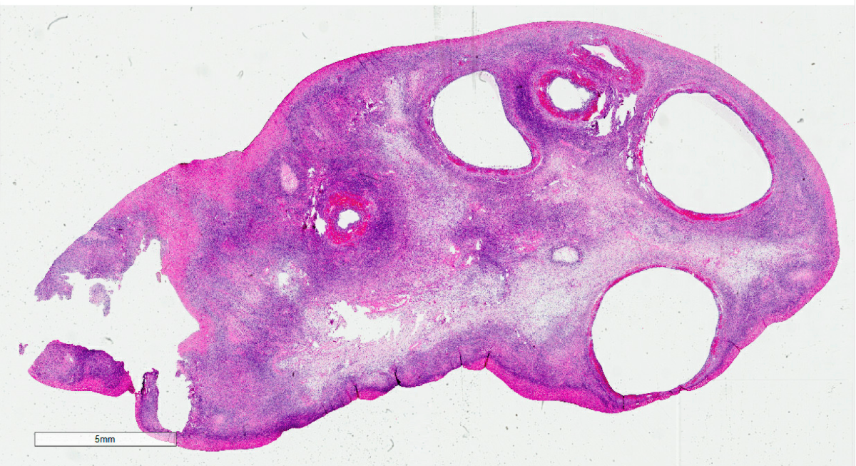 Multiple variably sized cysts and cystic follicles