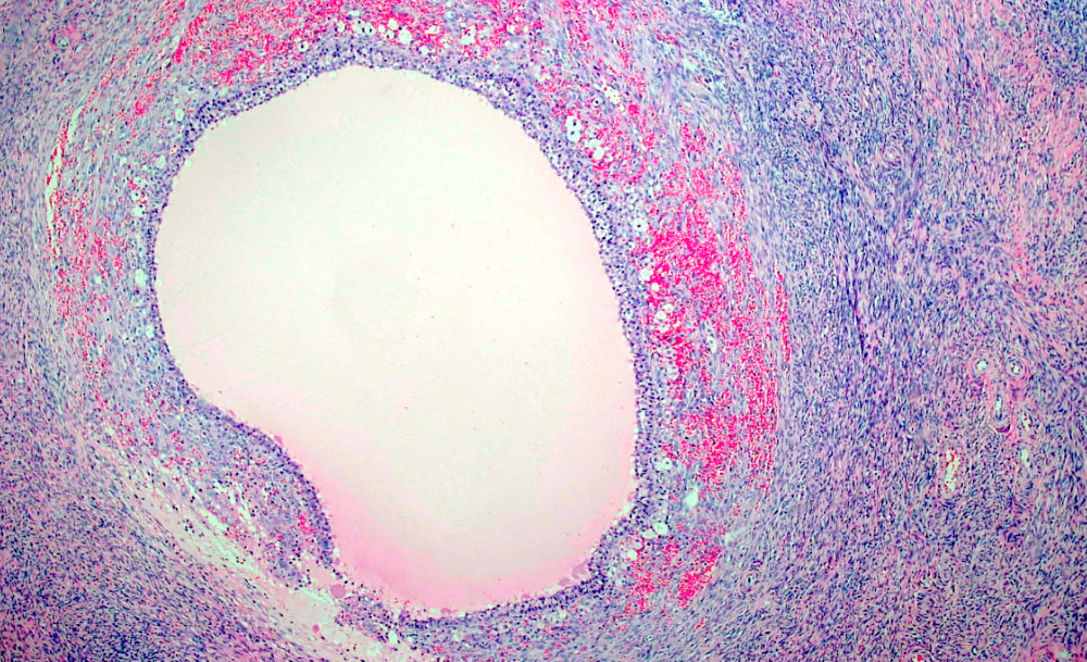 Atretic follicle with bands of luteinized theca cells