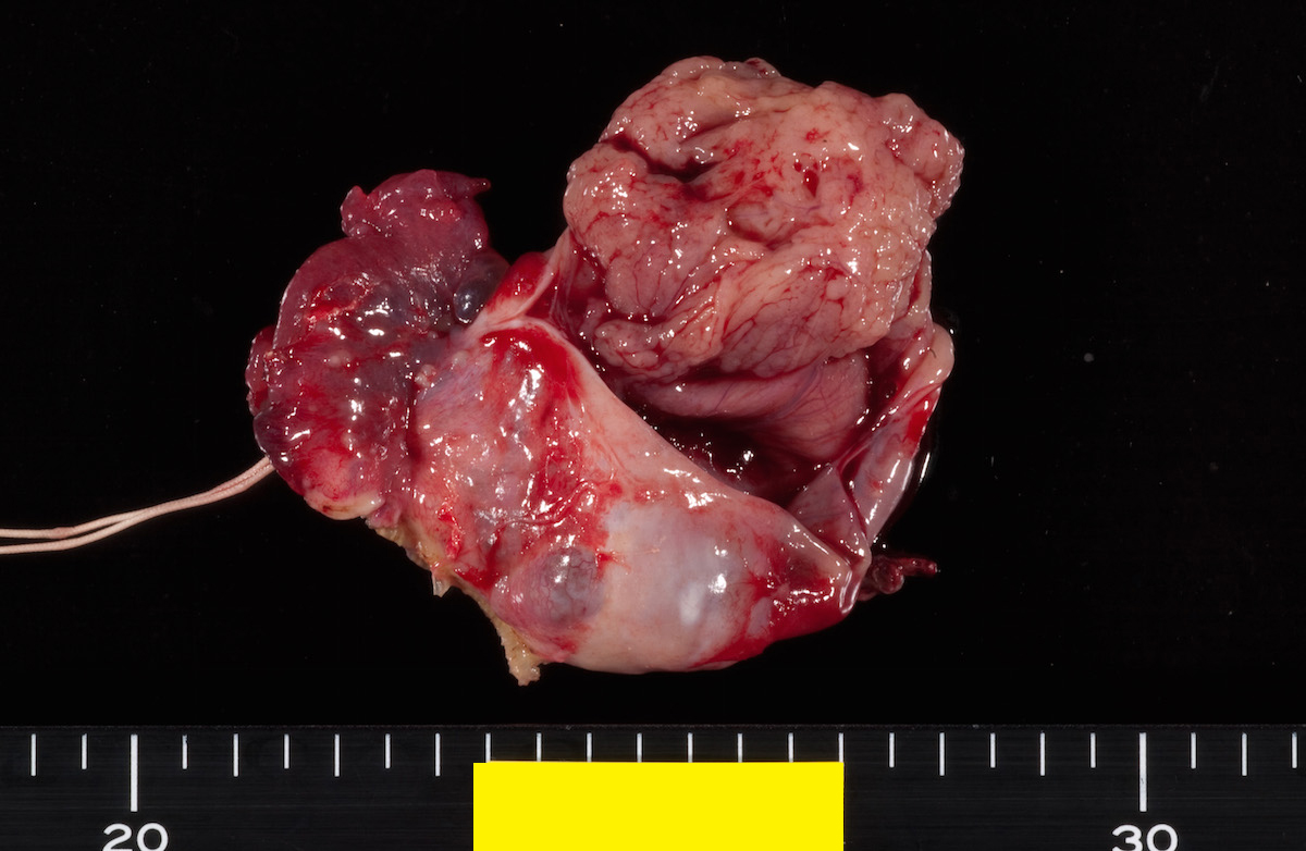 Partially opened cyst wall
