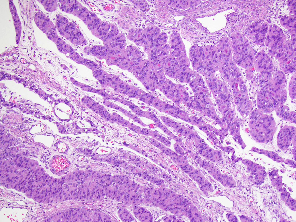 Trabecular pattern resembling sex cord stromal tumor