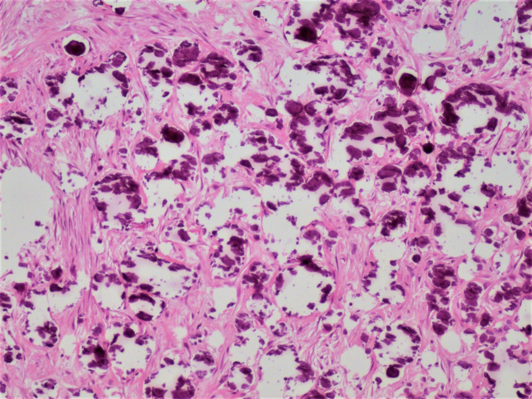 Calcifications associated with low grade serous carcinoma of the ovary