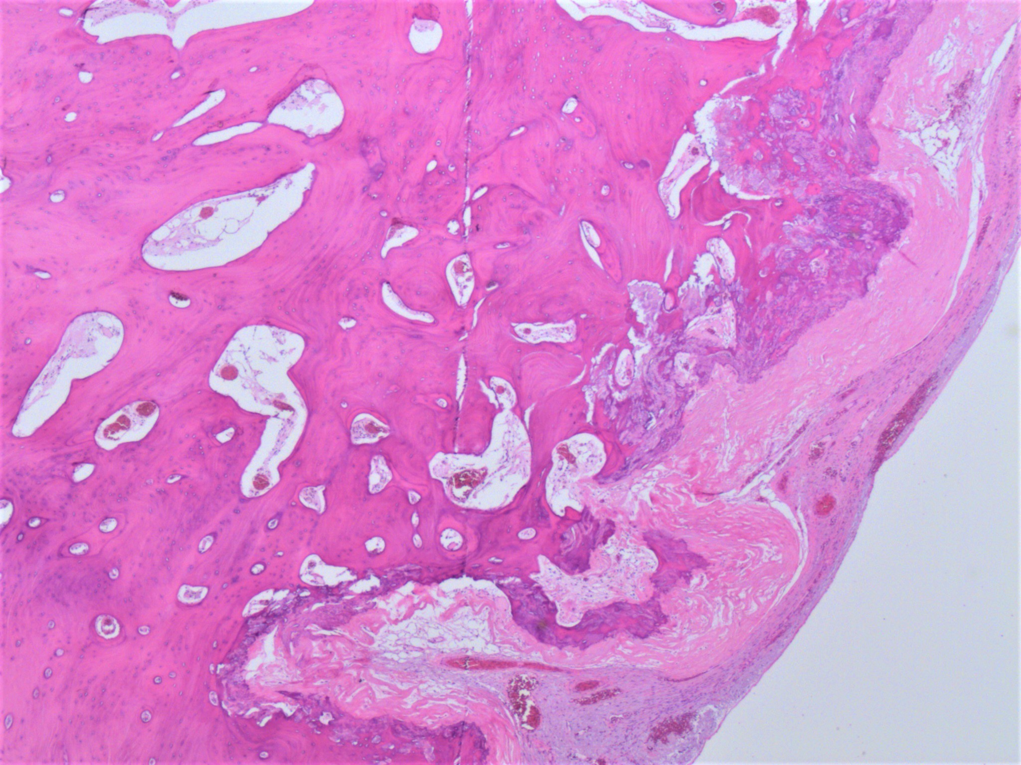 Osseous metaplasia of the ovary