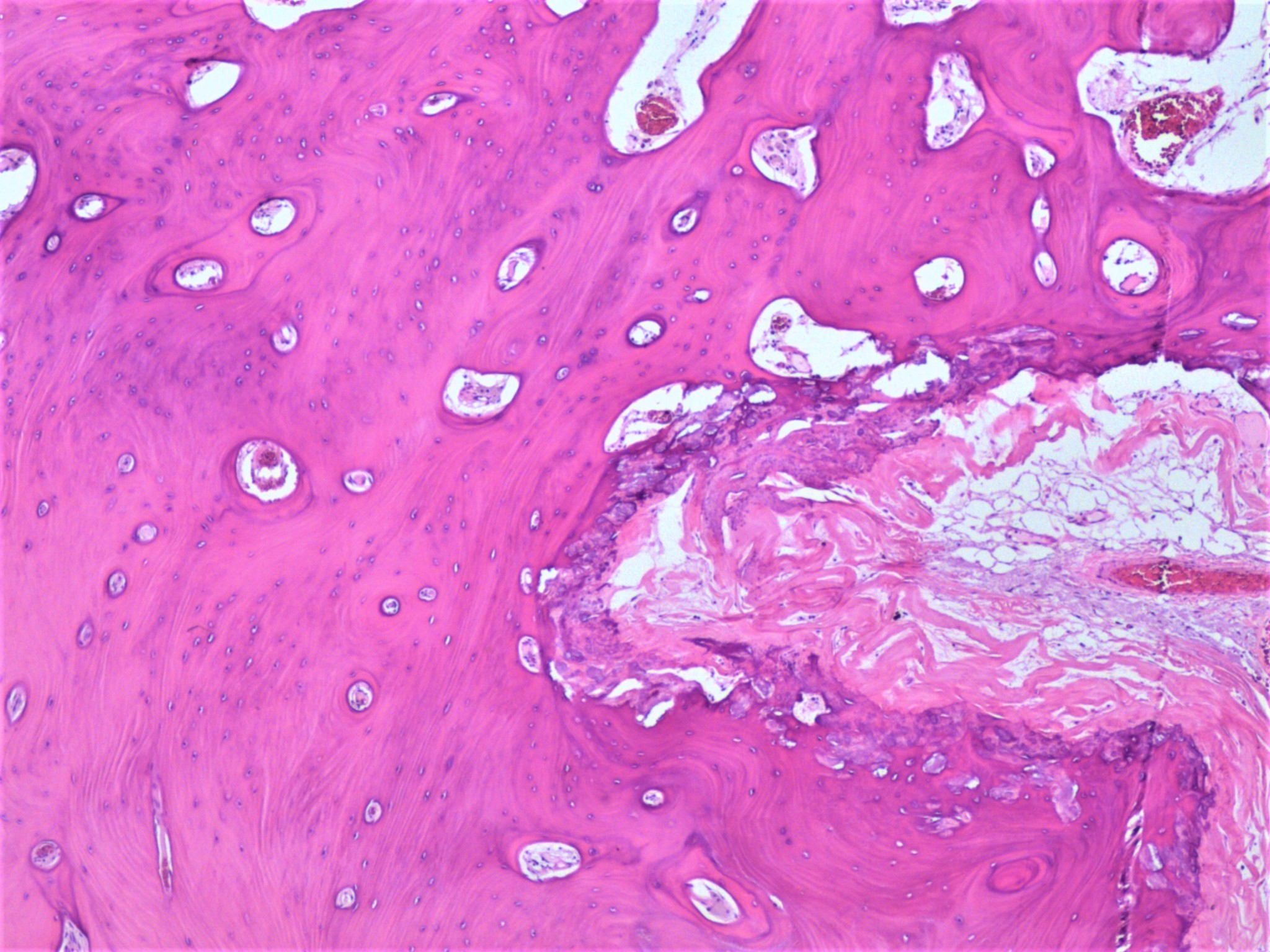 Osseous metaplasia of the ovary