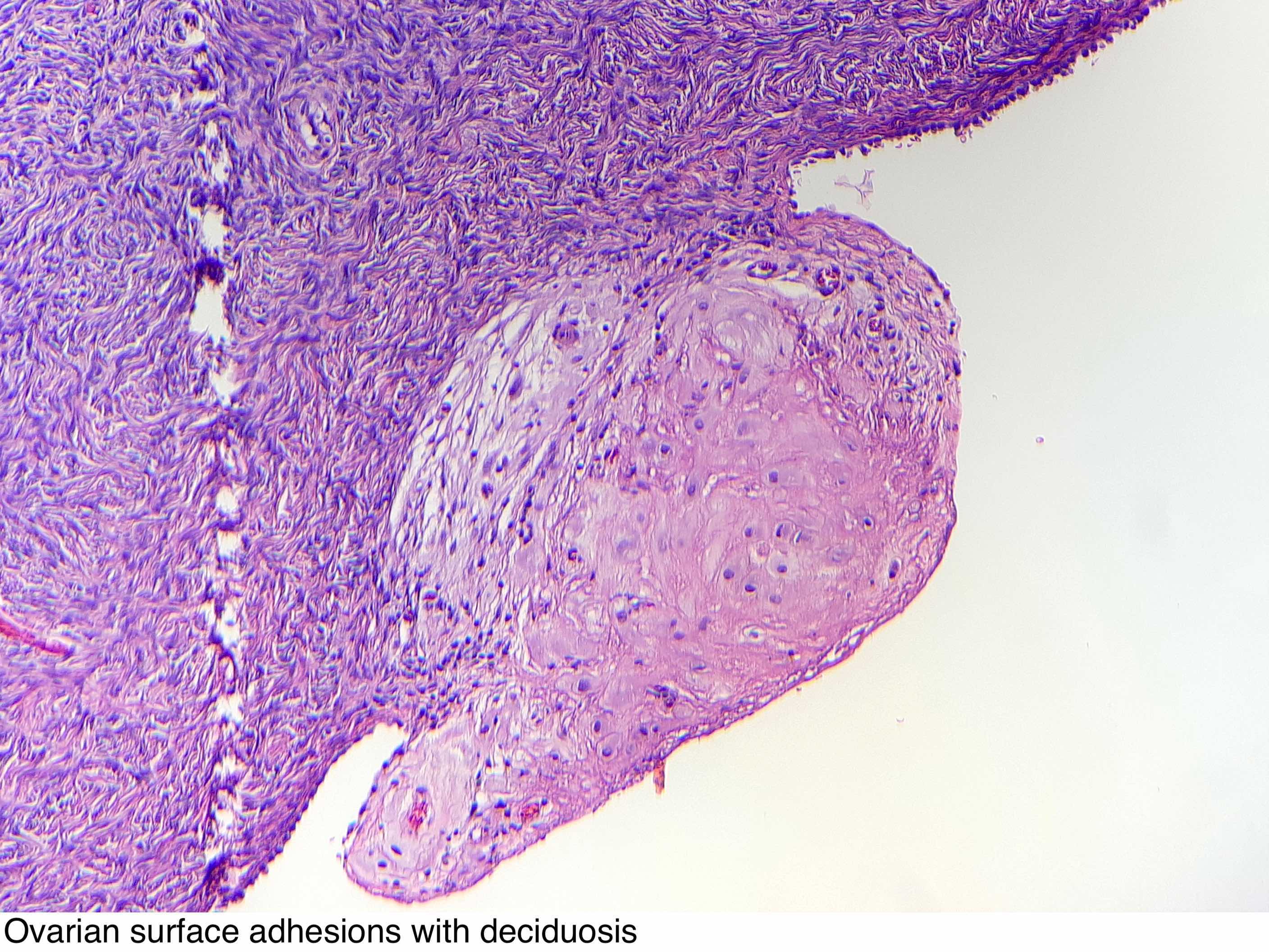 Ovarian surface adhesions with deciduosis.