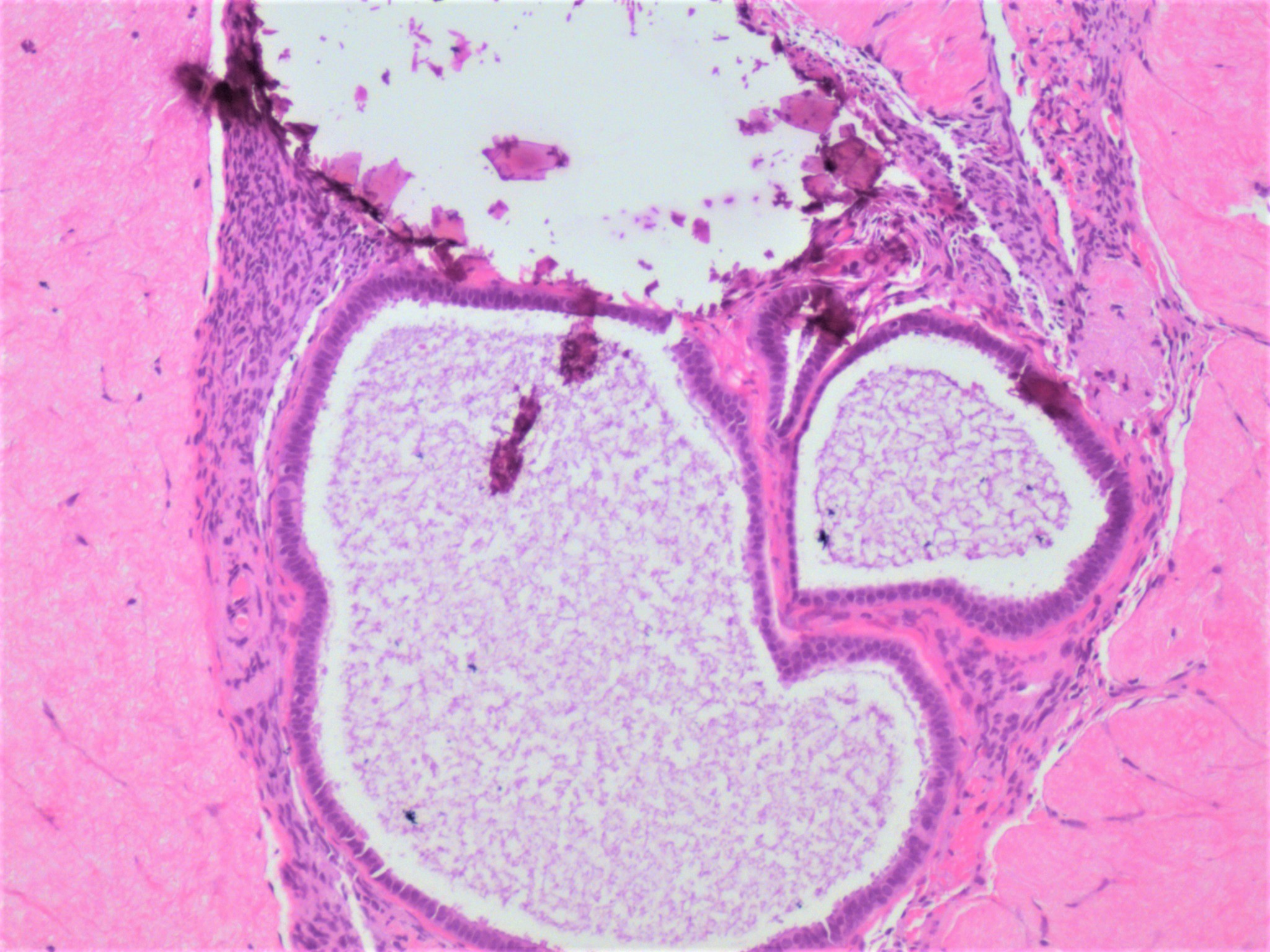 Stromal microcalcifications