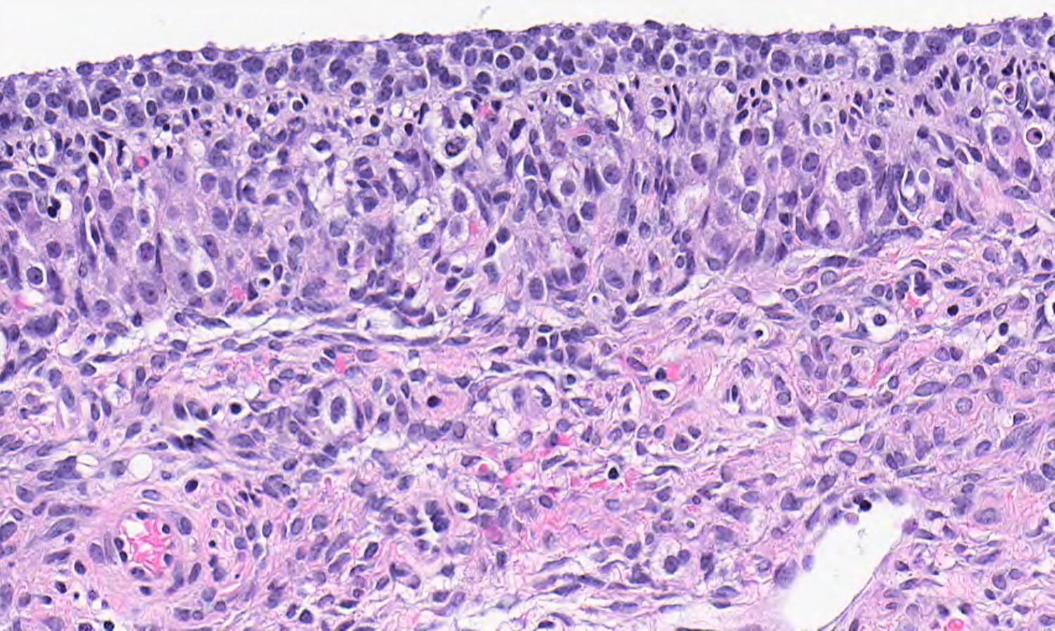 Luteinized theca cells