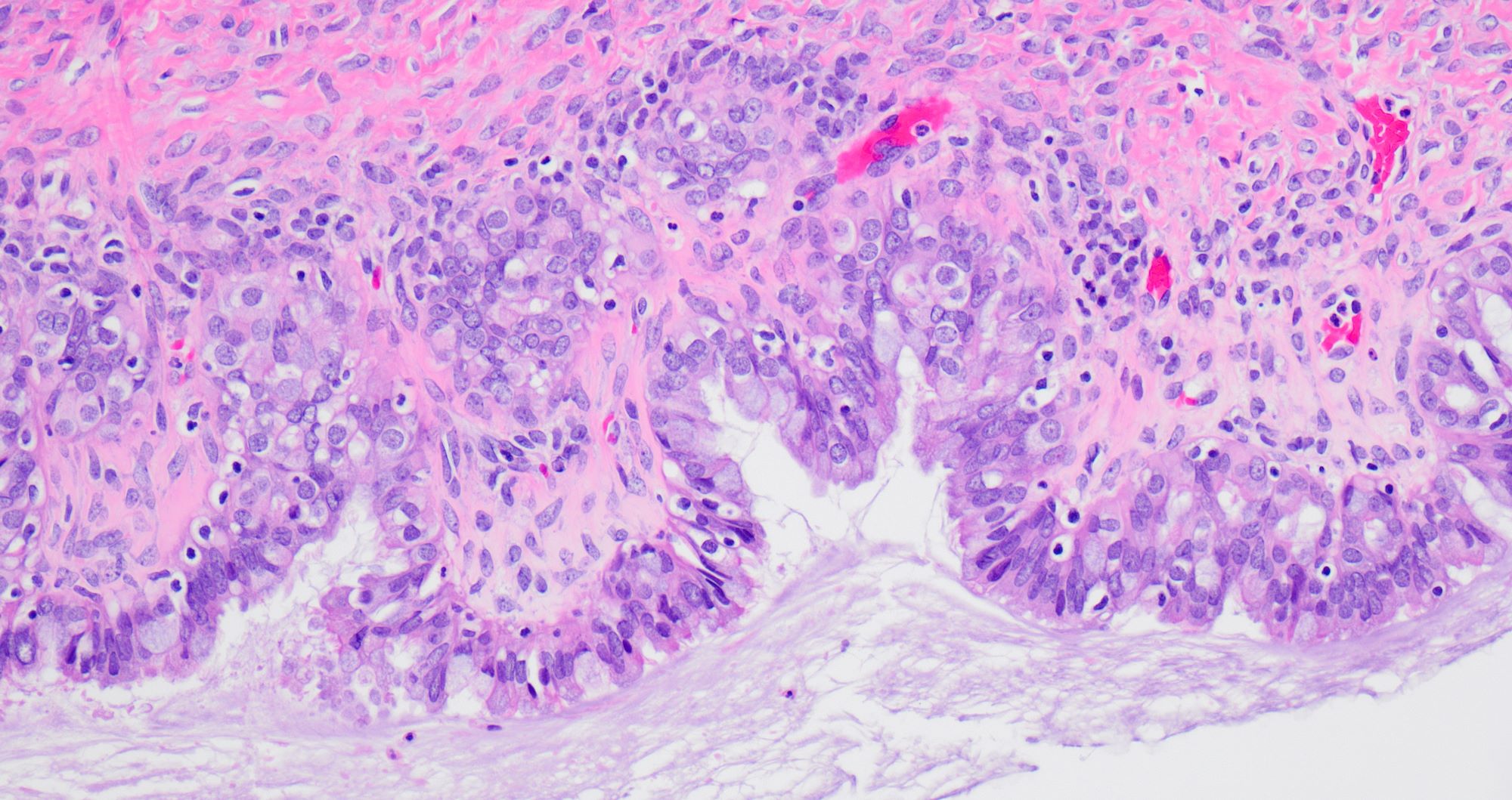 High power view of the cyst wall lined by simple epithelium consisting of serous type ciliated cells admixed with endocervical type mucinous cells