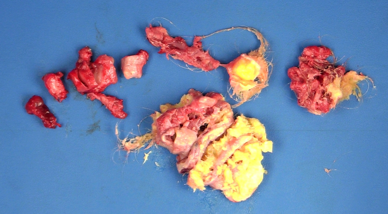 Fragmented ovarian mature teratoma