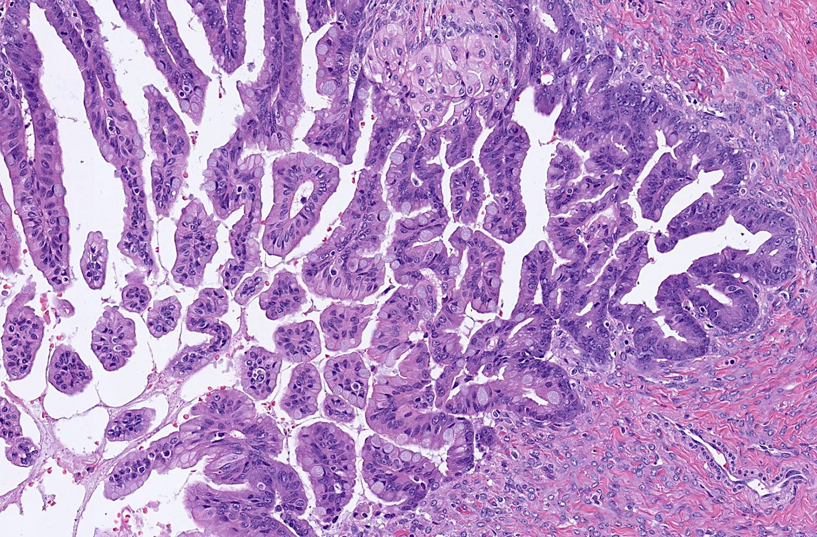 PDF) Factors associated with misdiagnosis of frozen section of mucinous  borderline ovarian tumor