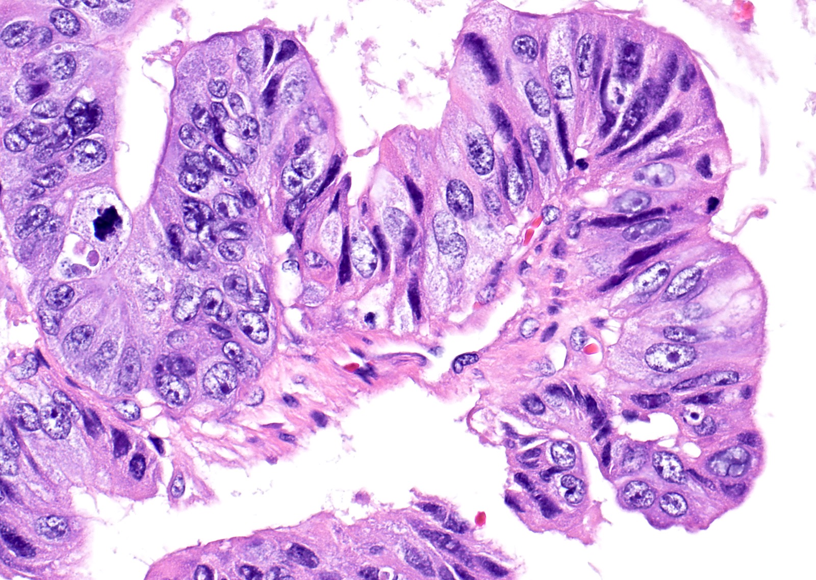 Intraepithelial carcinoma