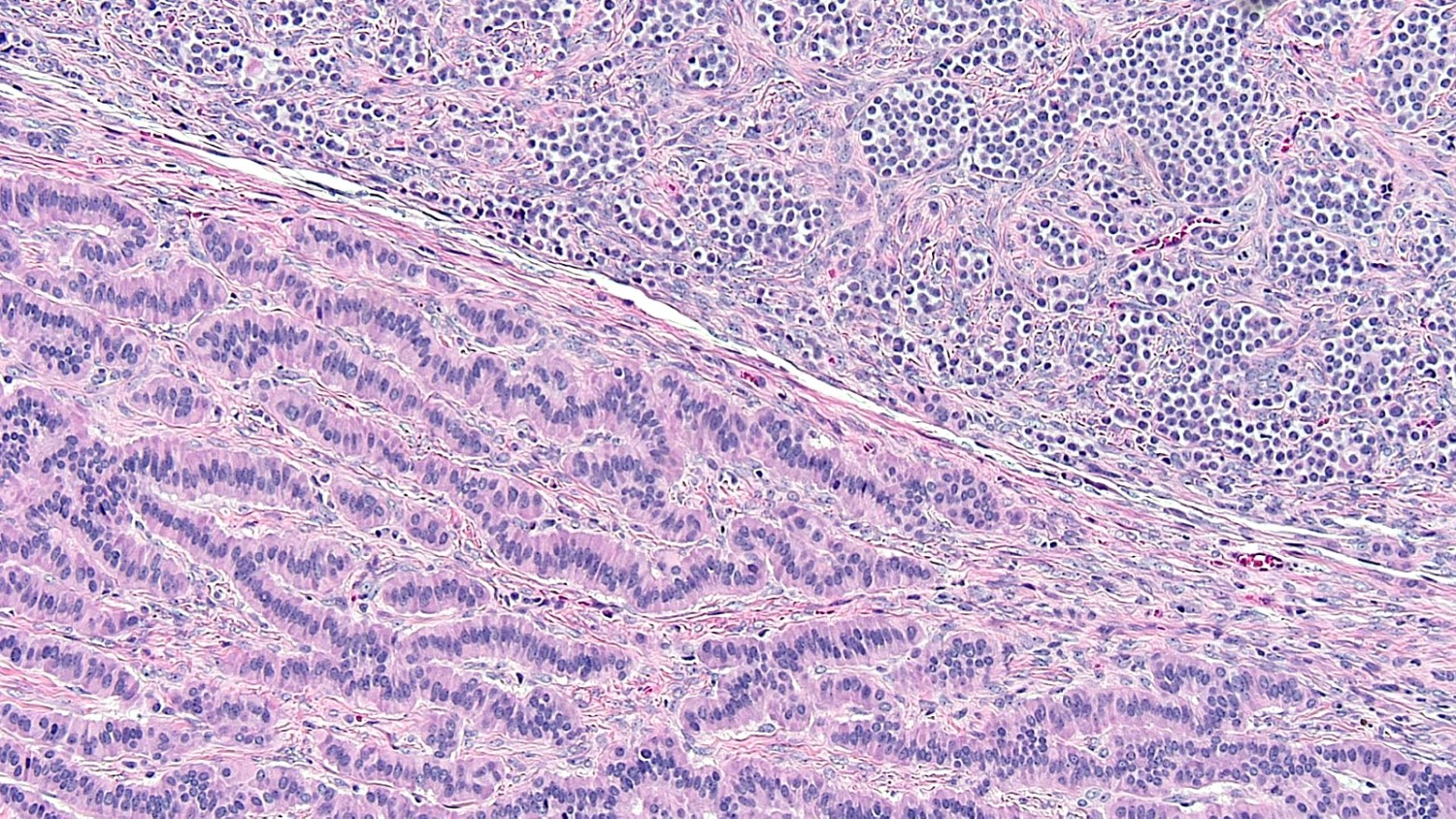 Pathology Outlines - Carcinoid tumor