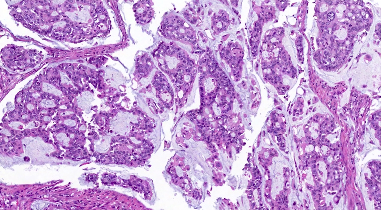 colon cancer stage pathology outlines Kegel Gyakorlat Prosztata Vélemények