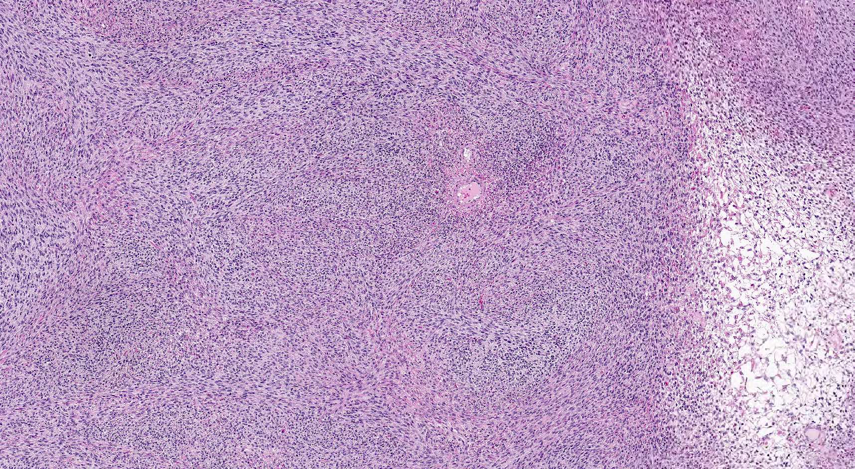 Cellular spindle cell neoplasm