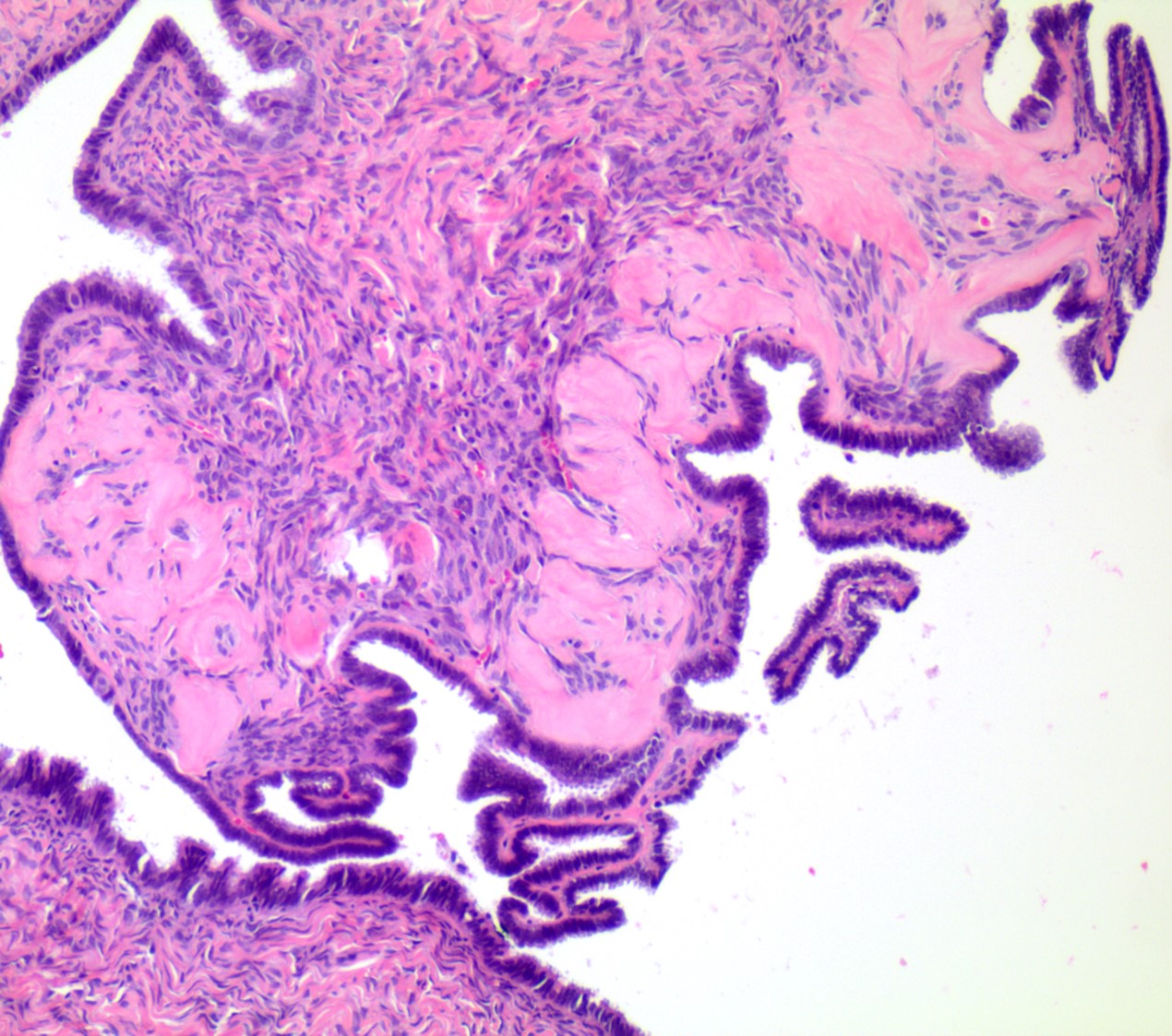 Serous cystadenoma with focal epithelial proliferation