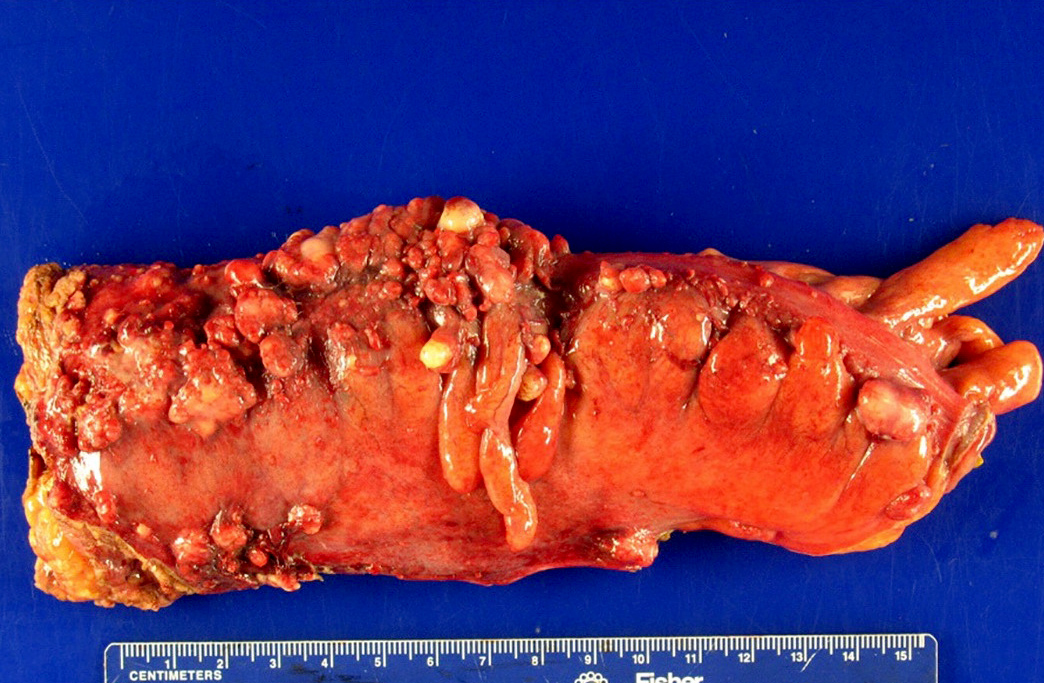 Rectosigmoid colon (pT2b)