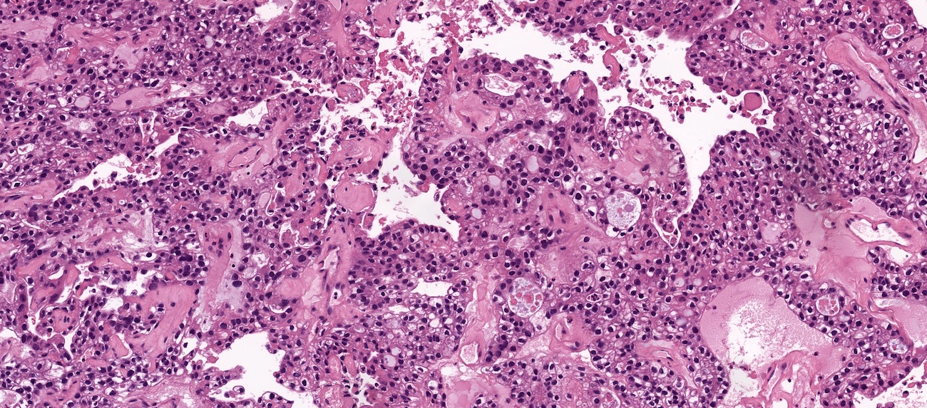 Clear cell carcinoma, ovary