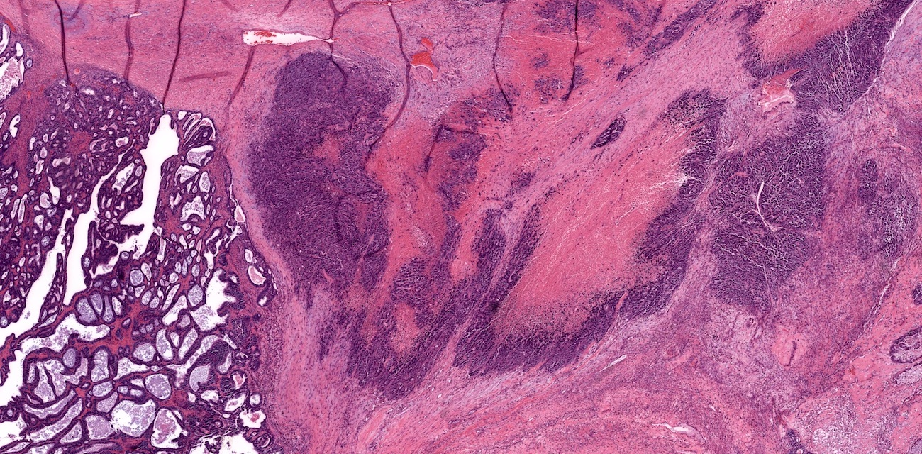 Dedifferentiated carcinoma in ovary