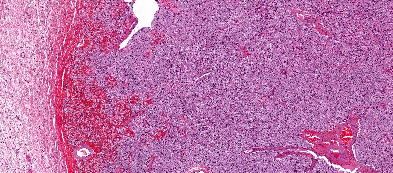 Steroid cell tumor, ovary
