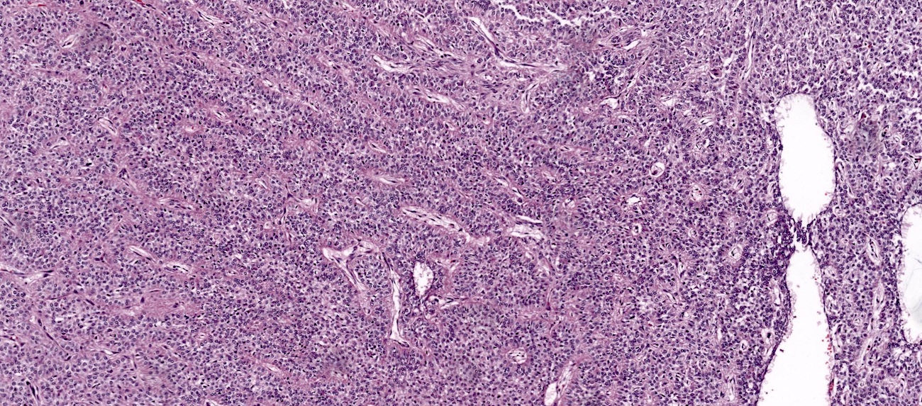 Granulosa cell tumor, adult type