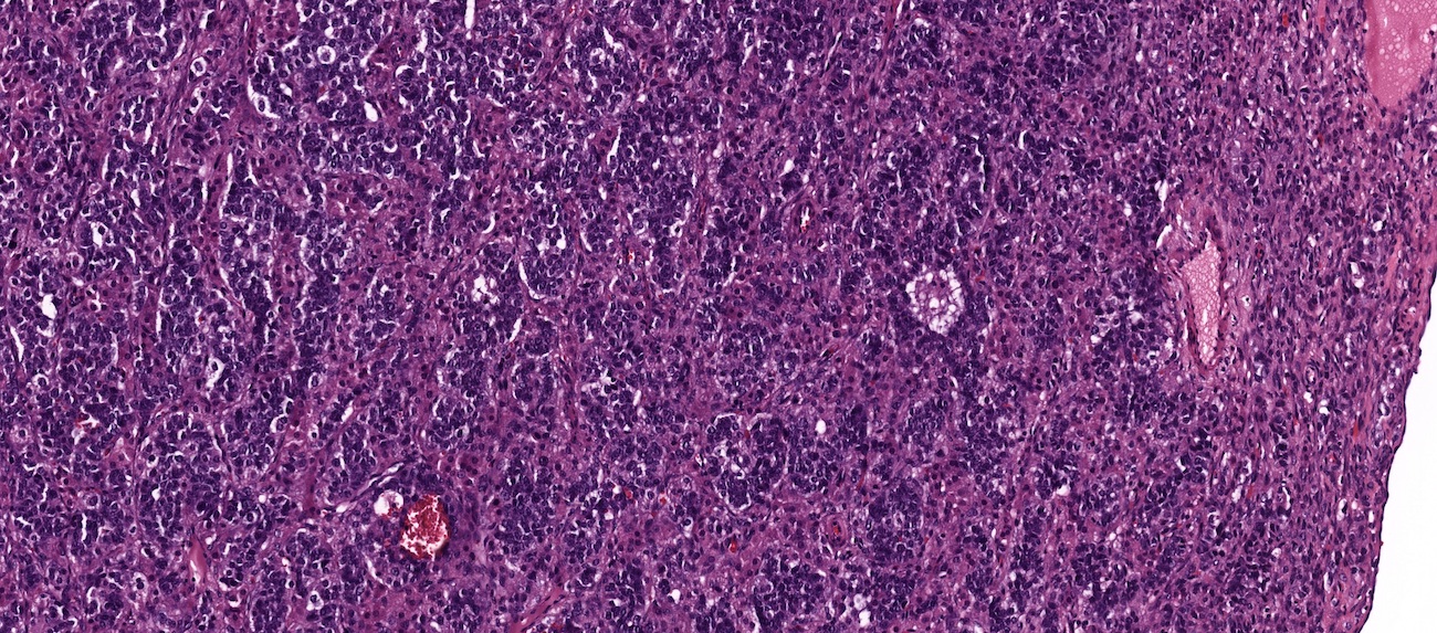 Sertoli-Leydig tumor, intermediate