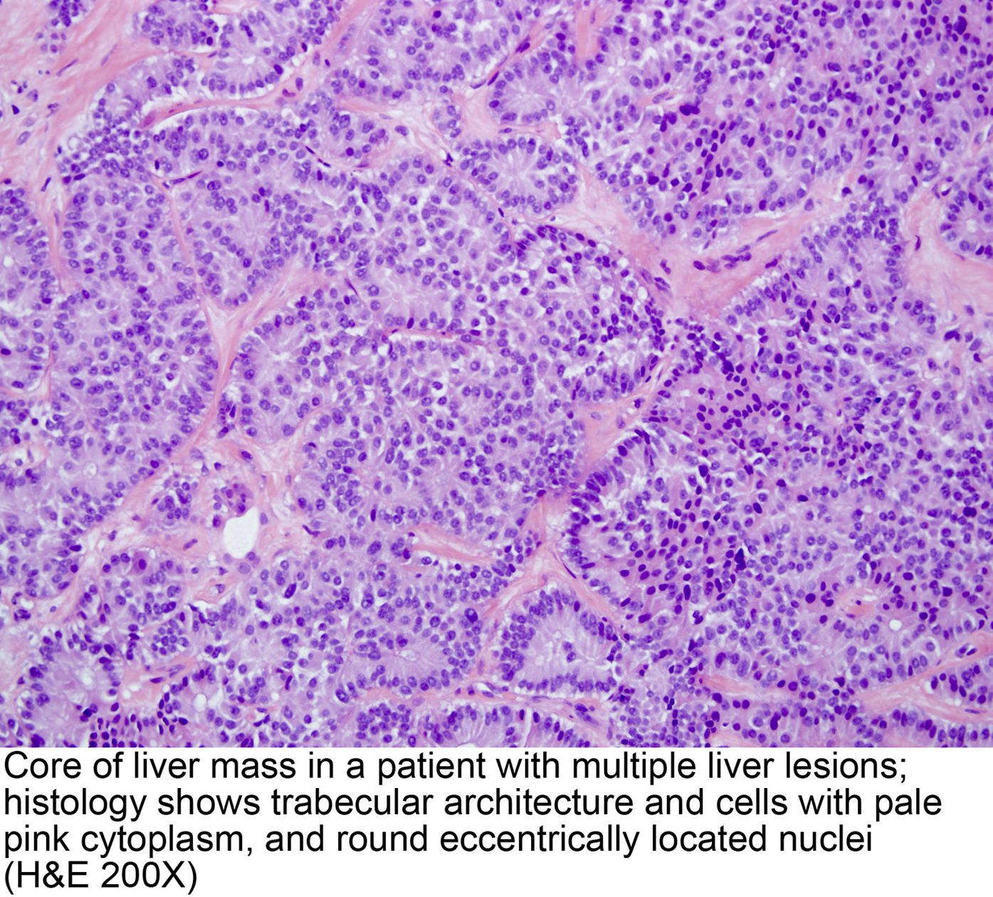 adenocarcinoma with neuroendocrine differentiation pathology outlines)