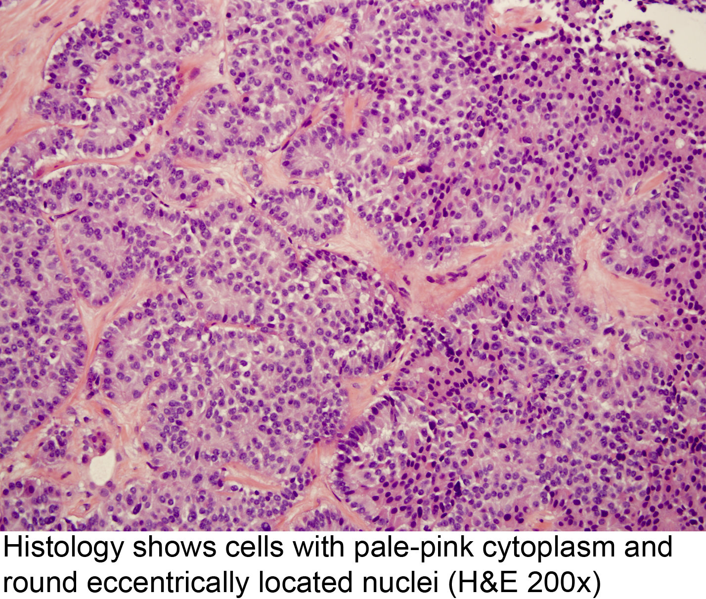 Papillary urothelial hyperplasia pathology - Cauzele condilomului cervical