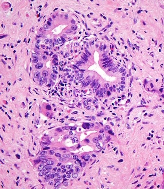 ductal adenocarcinoma prostate pathology outlines)