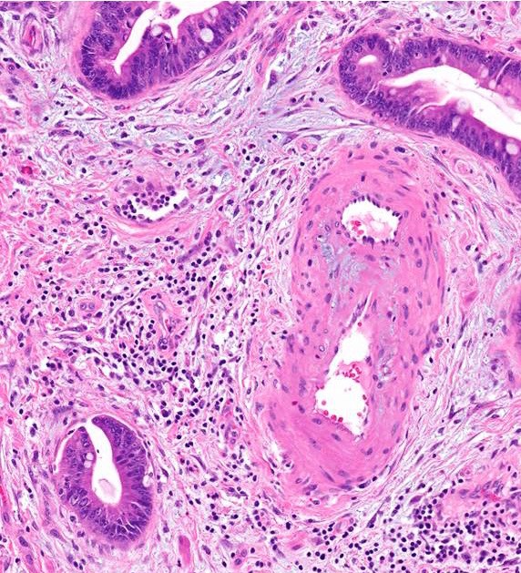 prostate ductal adenocarcinoma pathology outlines