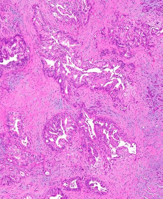 prostate ductal adenocarcinoma pathology outlines gyökér a prosztatitis vizelésével