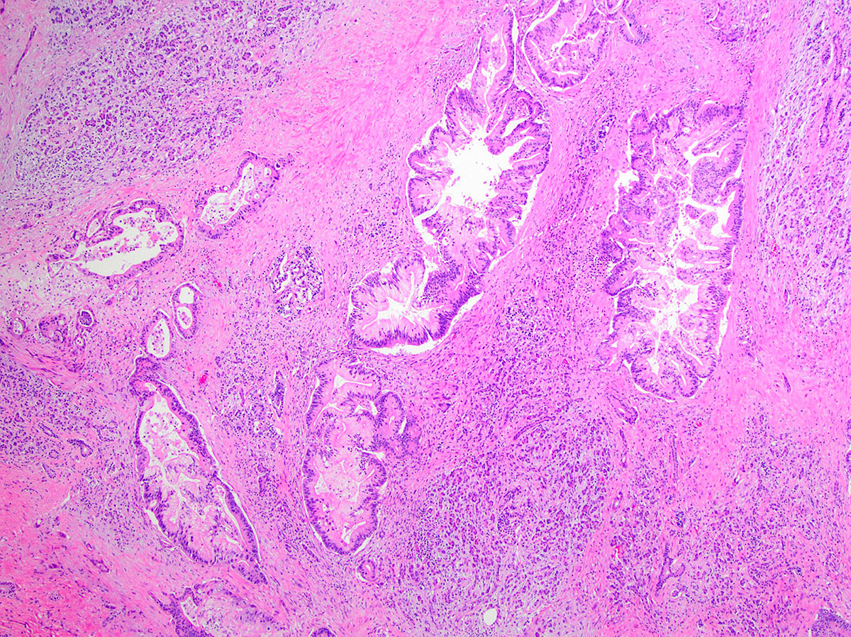 Neuroendocrine cancer pathology outlines - Schistosomiasis agent